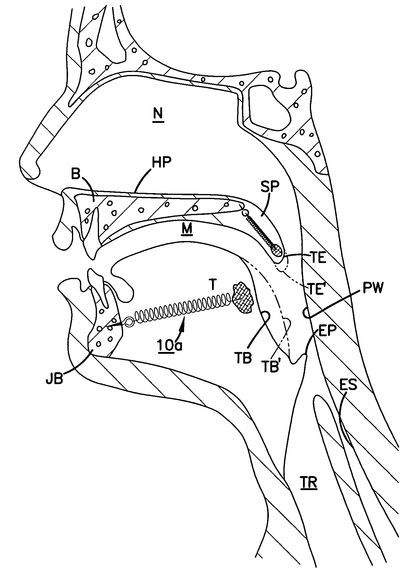 Airway implant