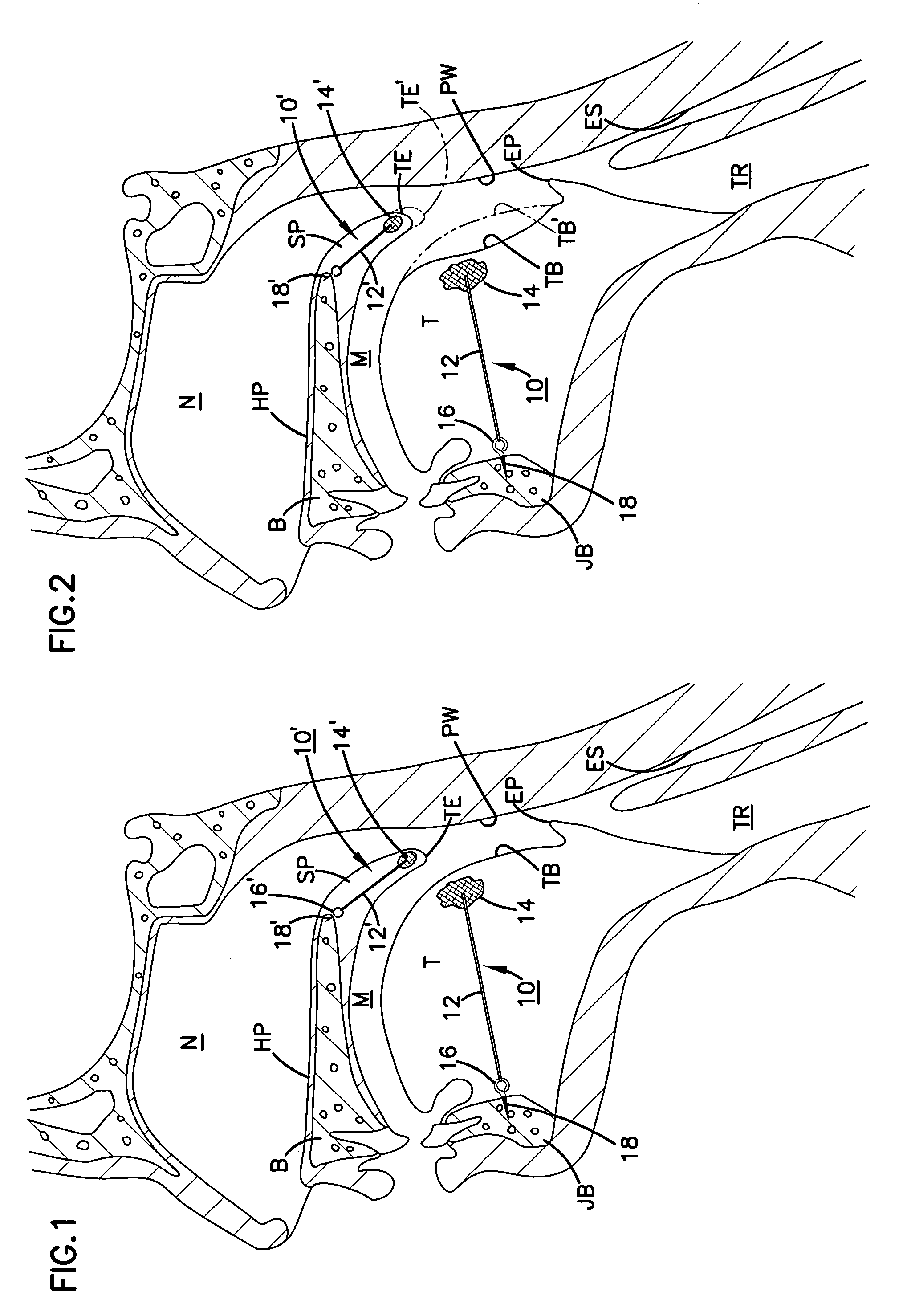 Airway implant