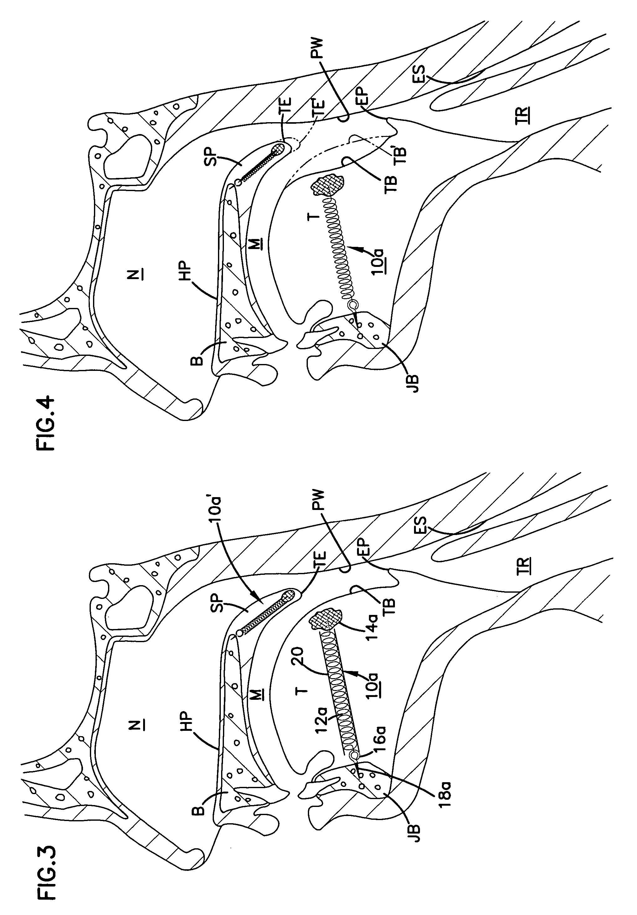 Airway implant