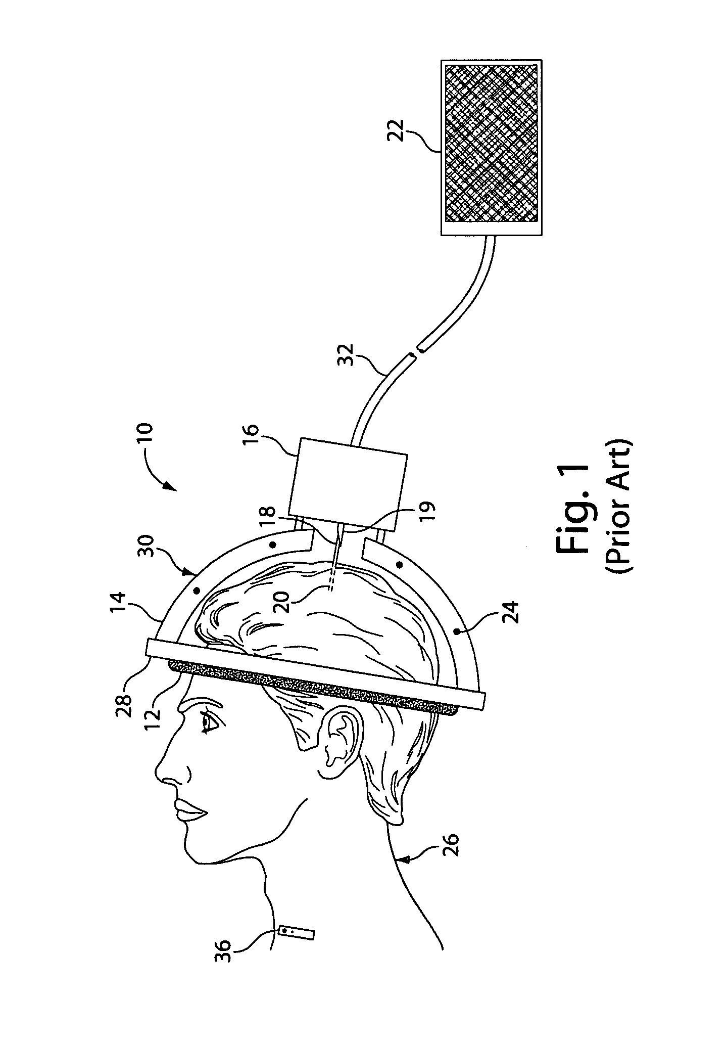 Deep brain stimulation