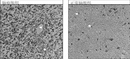 Method for targeted inhibition of infiltration and transfer of glioma cells and application of method