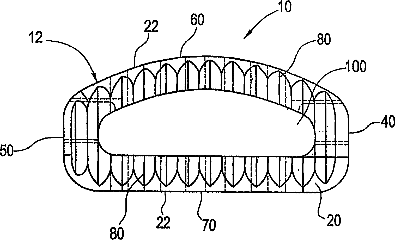 Spinal fusion implant