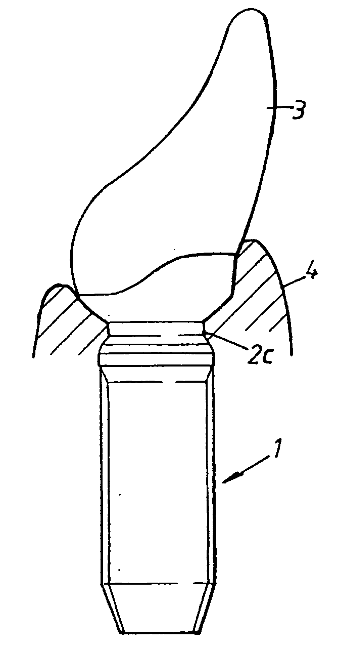 Dental implant arrangement