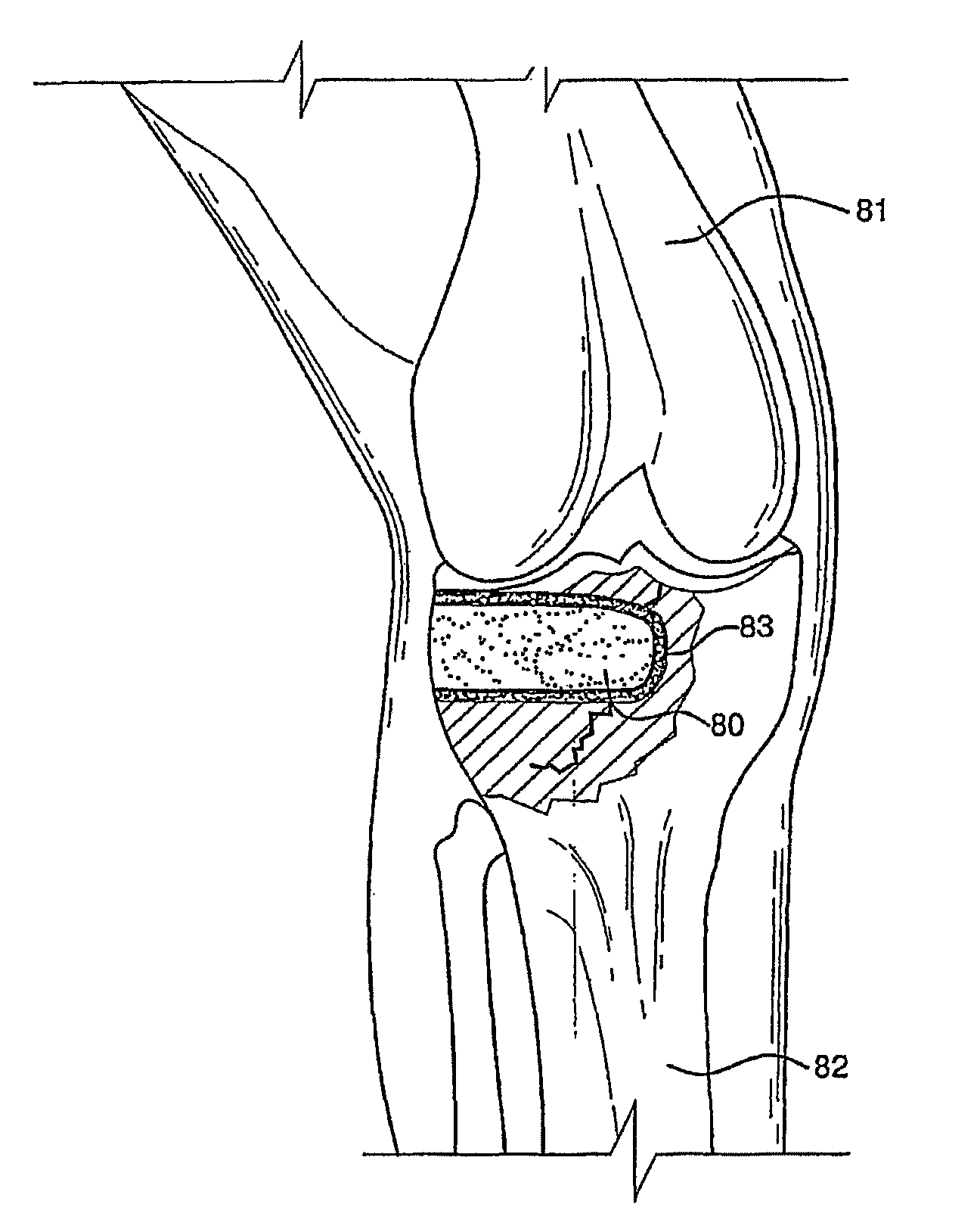 Bioactive antibacterial bone graft materials