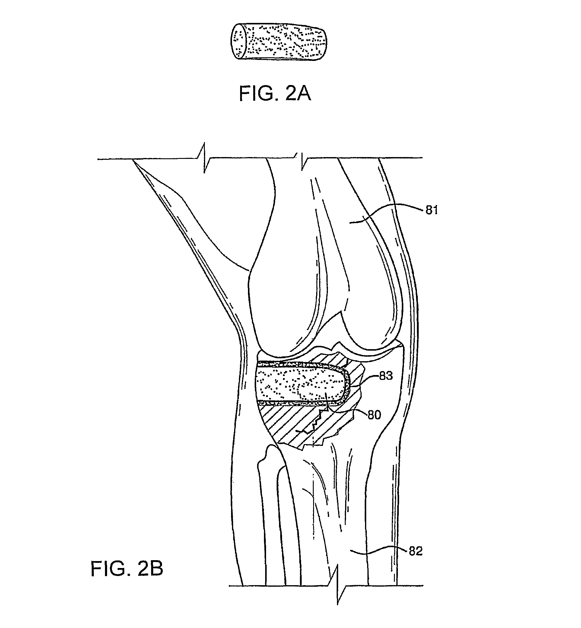 Bioactive antibacterial bone graft materials