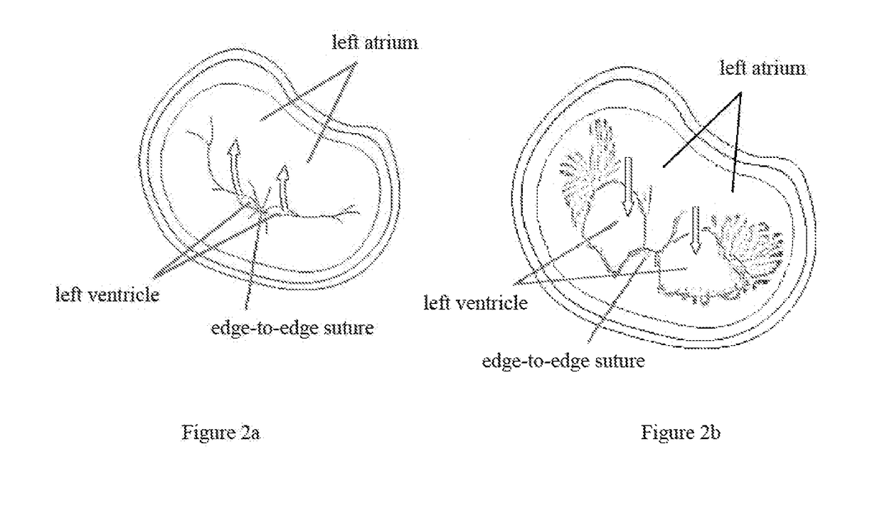 Valve clamp