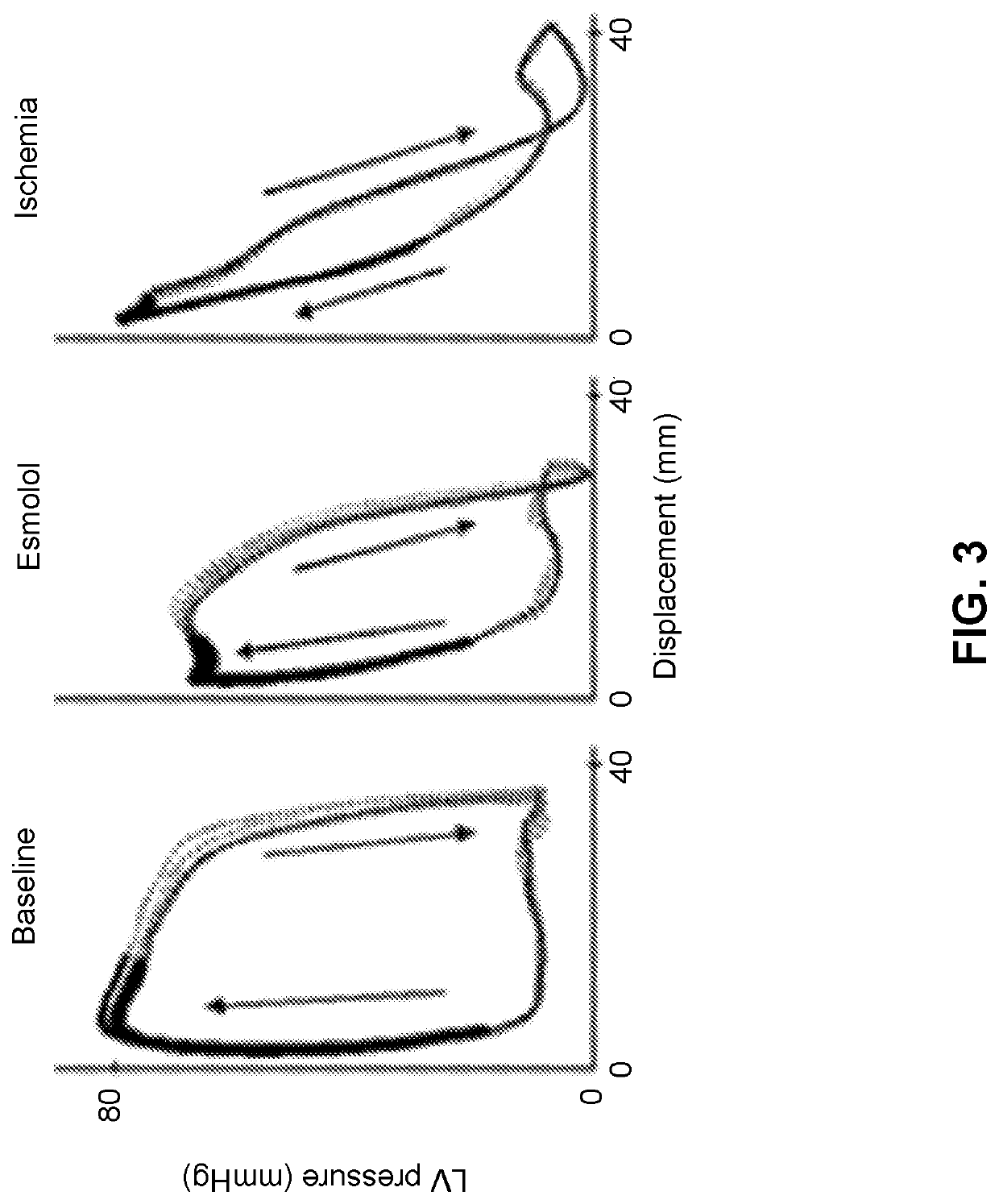 Methods and Apparatus to Estimate Ventricular Pressure