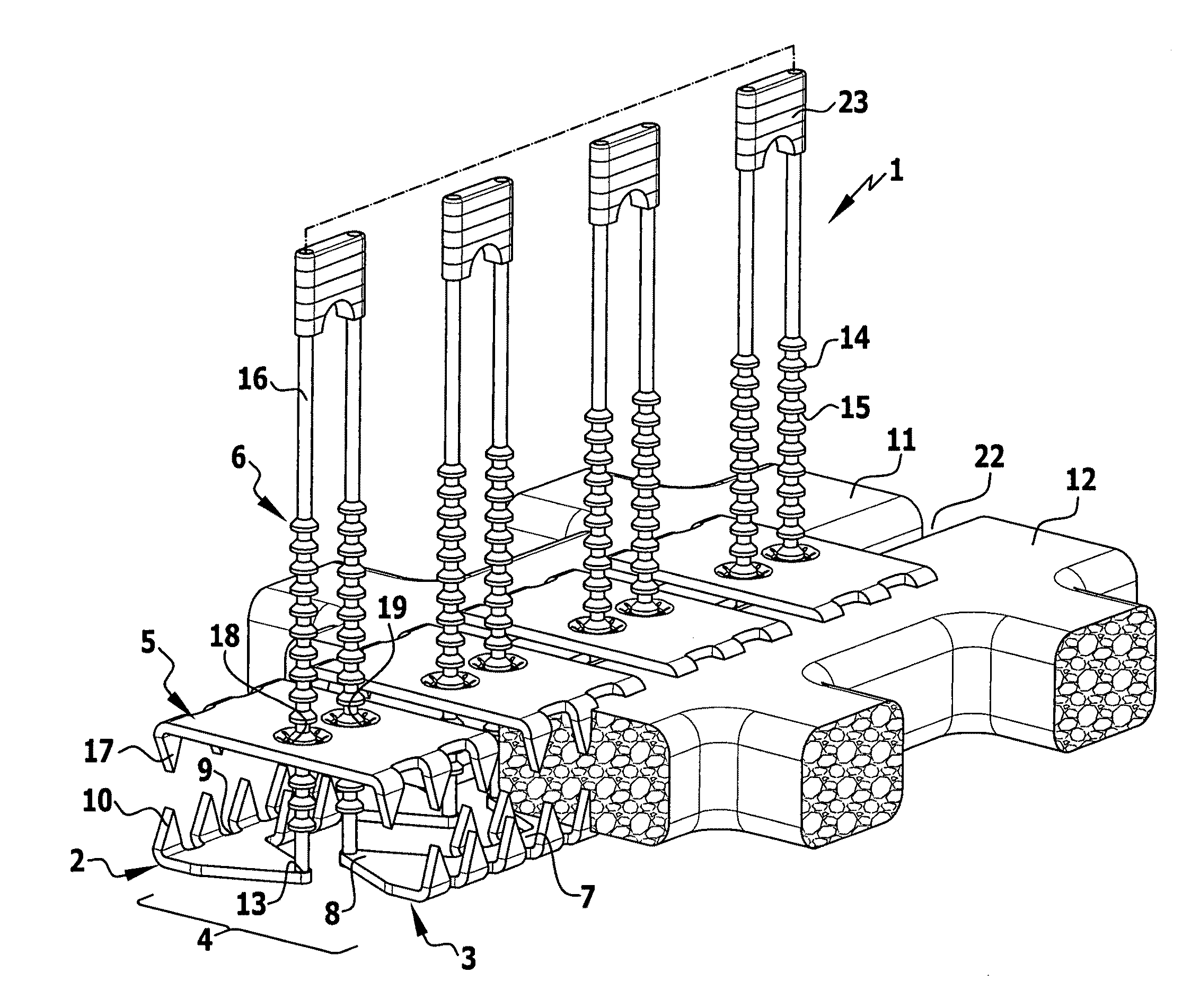 Sternum closure device