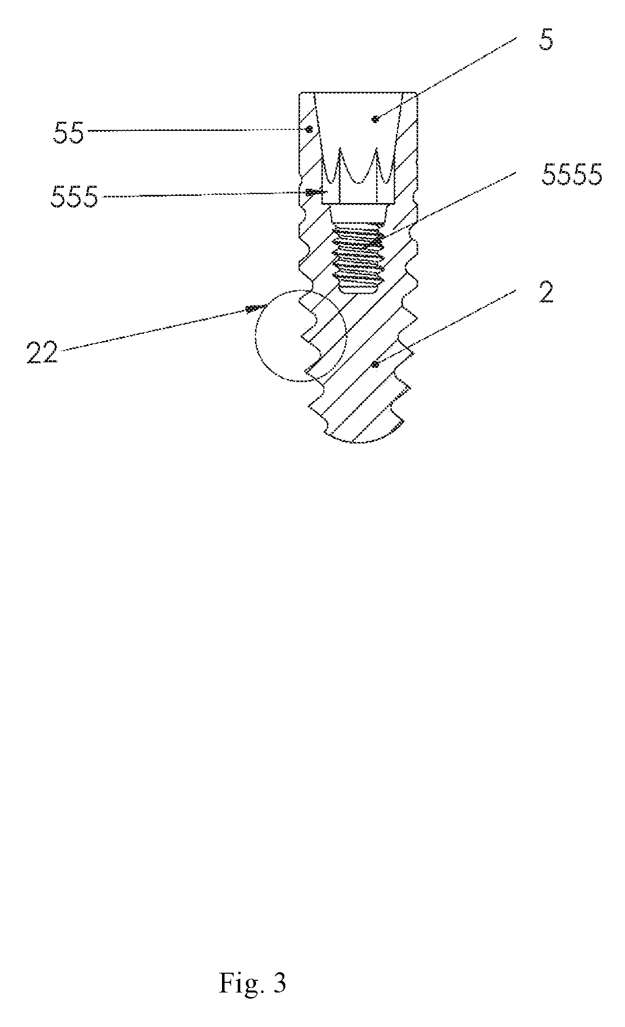 Dental implant