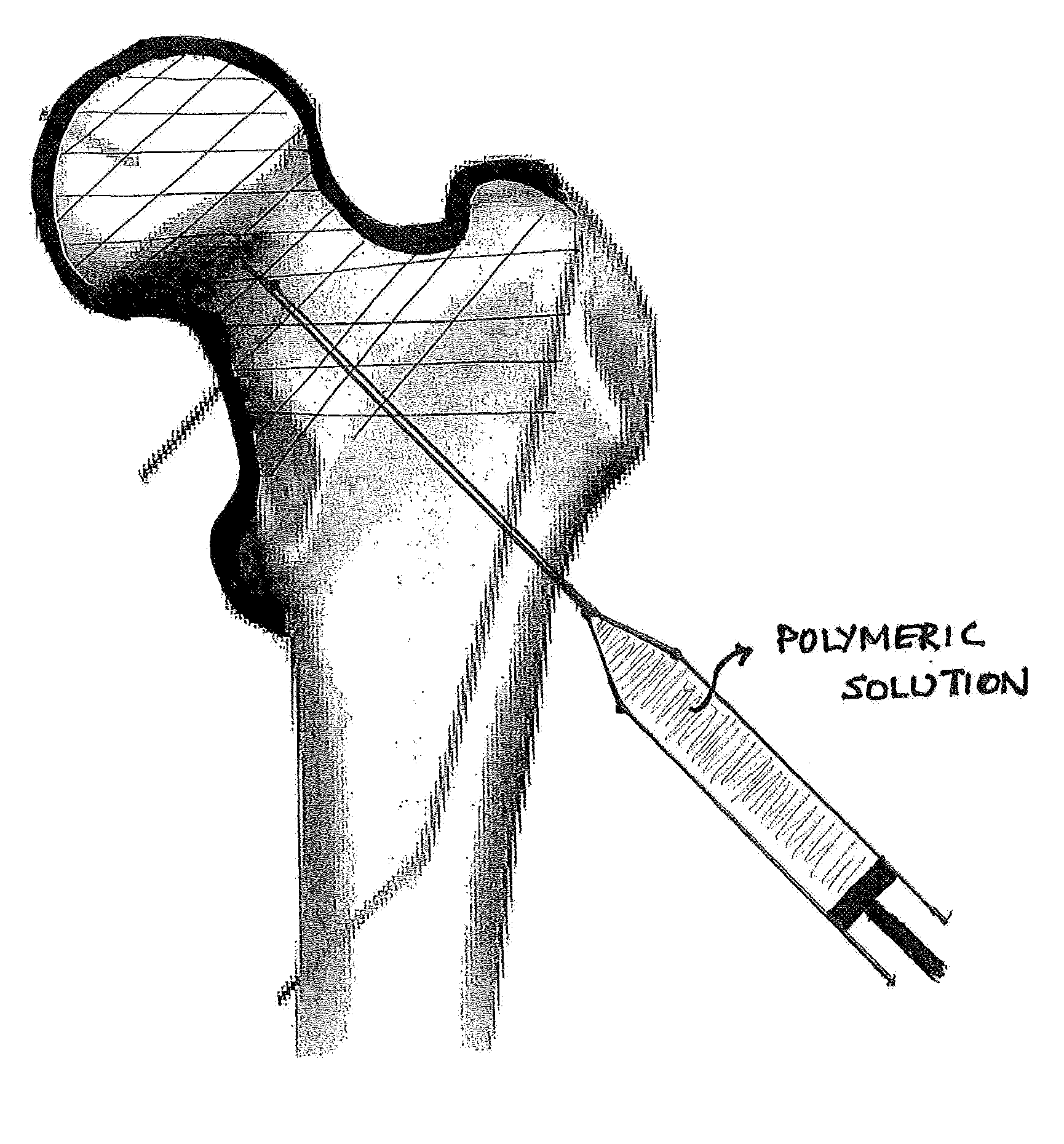 Device, Composition and Method for Prevention of Bone Fracture and Pain