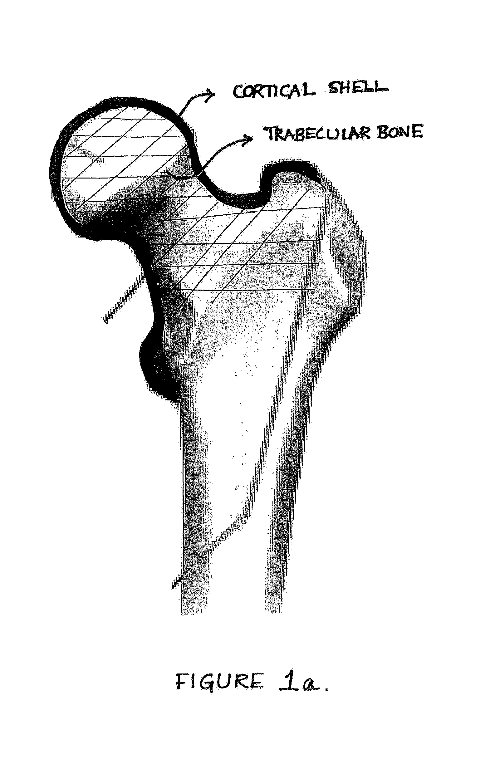 Device, Composition and Method for Prevention of Bone Fracture and Pain