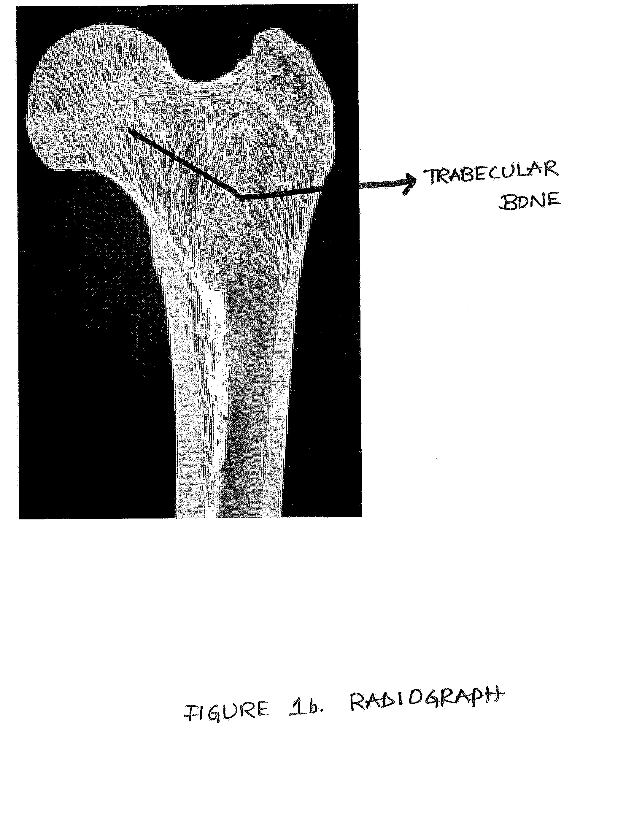 Device, Composition and Method for Prevention of Bone Fracture and Pain