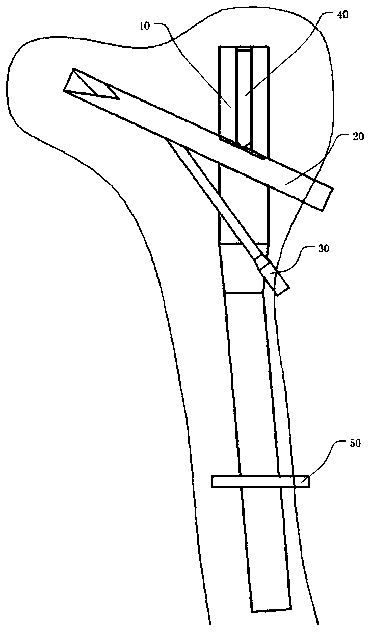 Intramedullary nail system for treating proximal femoral fractures