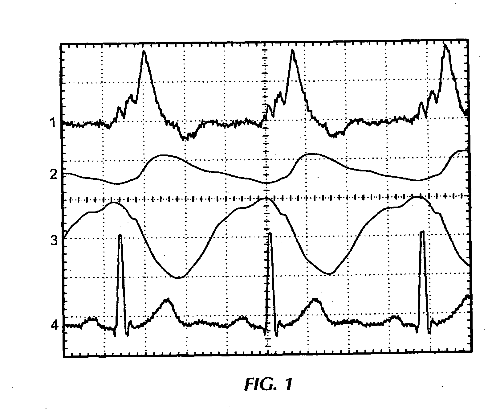 Apparatus and method for non-invasive, in-vivo, thoracic radio interrogation