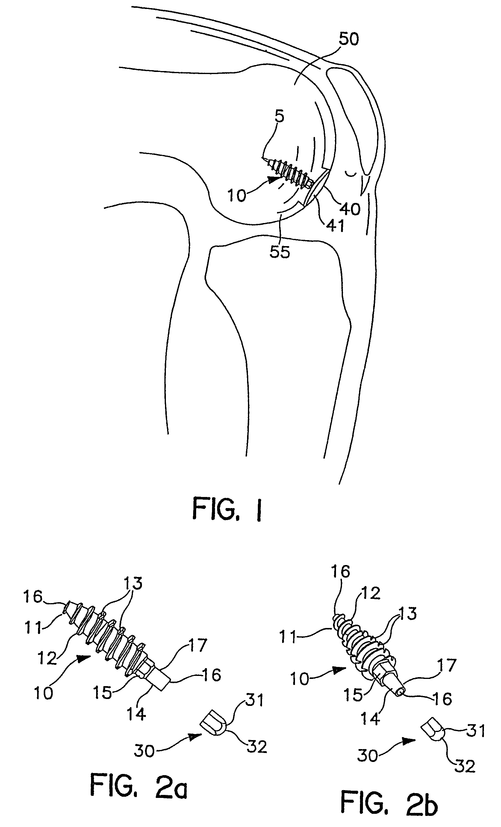 System and method for joint resurface repair