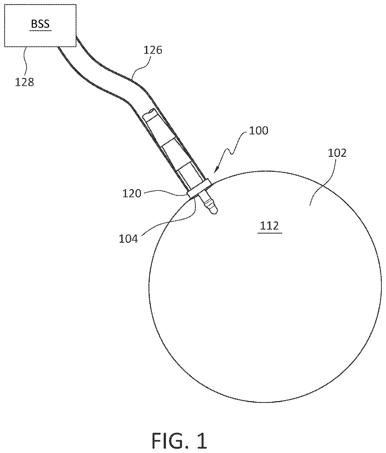 Anterior chamber maintainer (ACM)