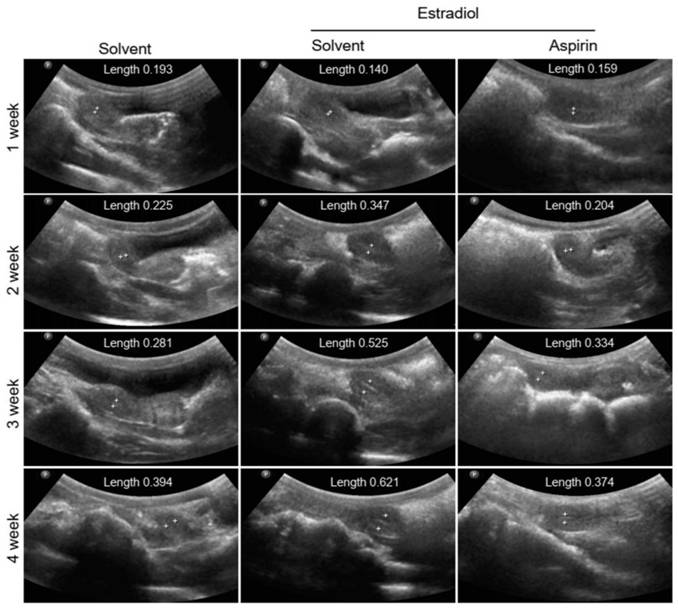 Application of aspirin in preparation of medicine for treating endometrial hyperplasia