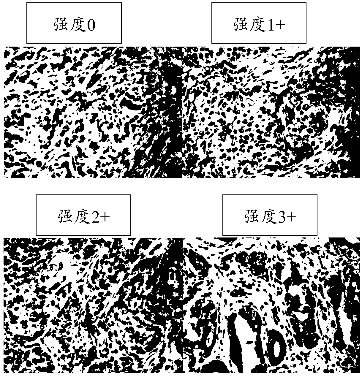 Kit for detecting ER-alpha 36 expression level in tumour tissue