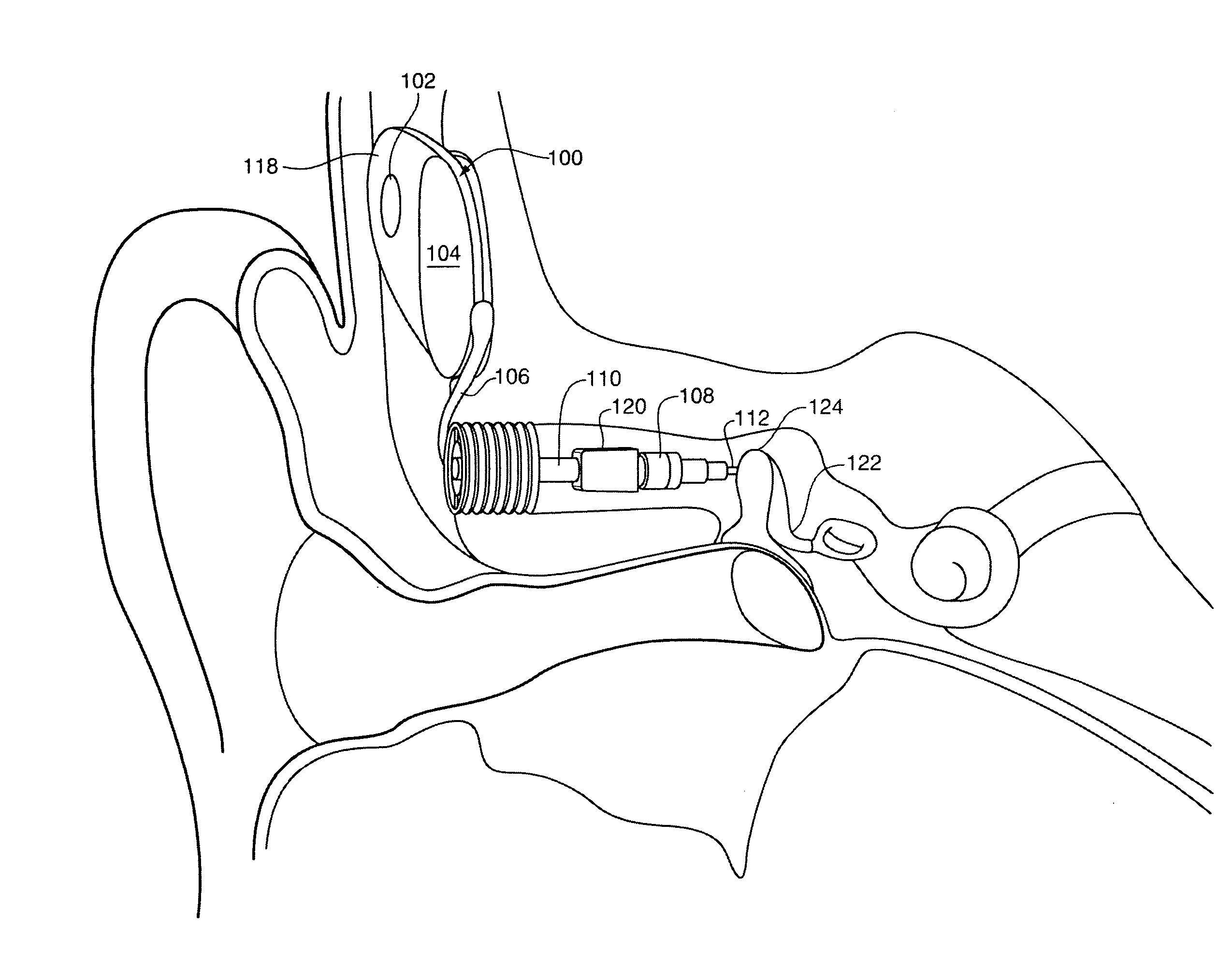 Implantable hearing aid transducer interface