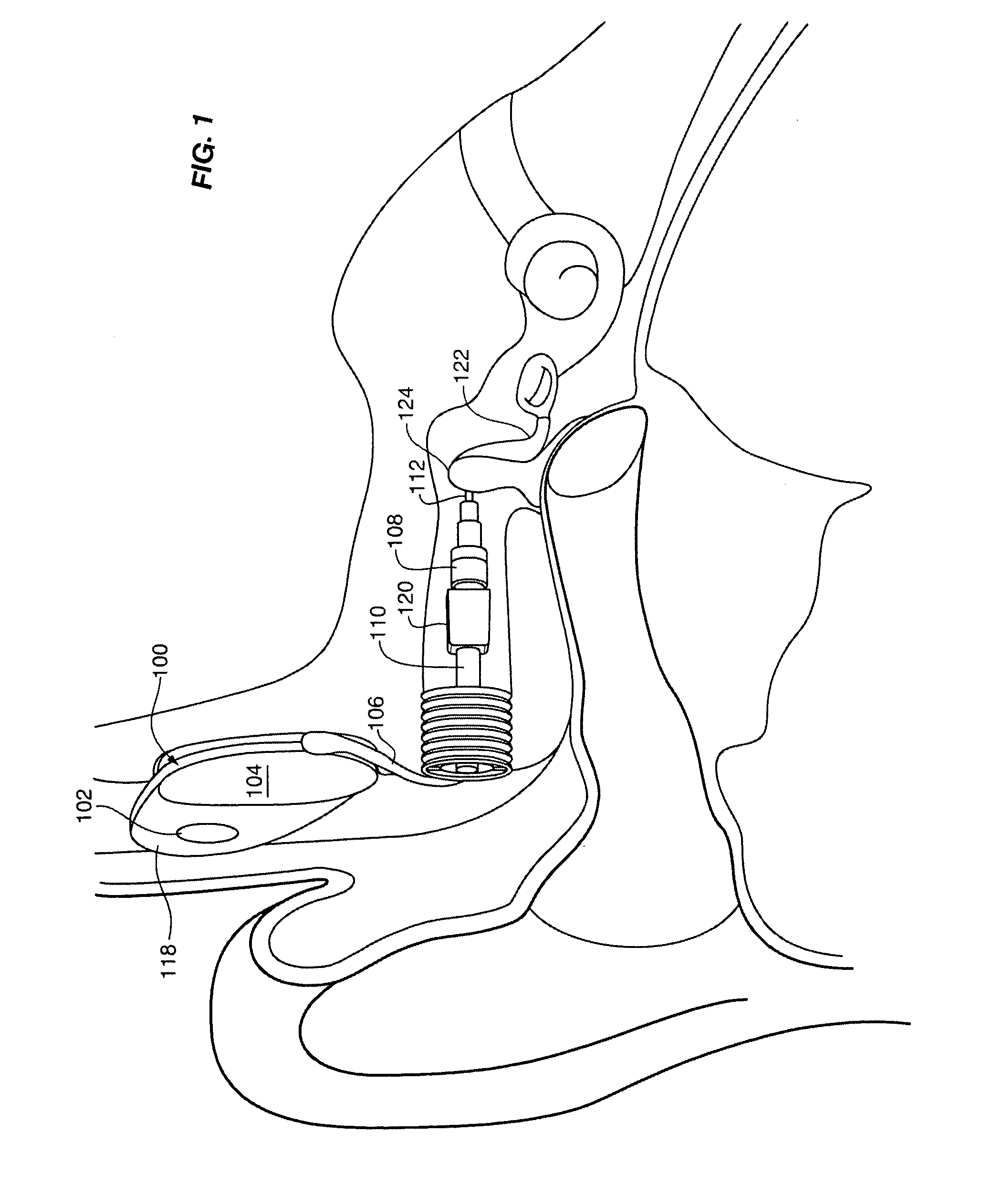 Implantable hearing aid transducer interface