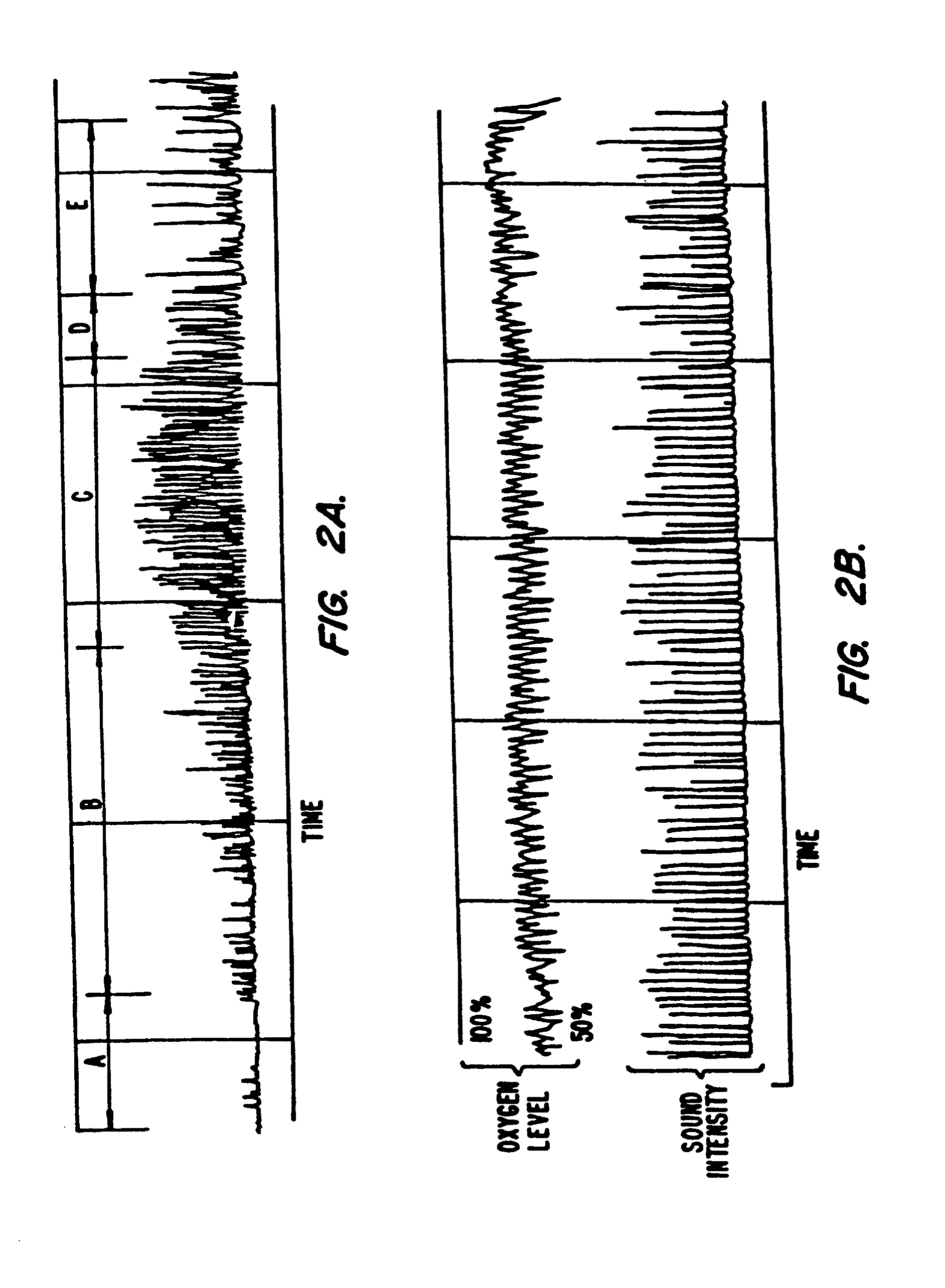 Method and apparatus useful in the diagnosis of obstructive sleep apnea of a patient