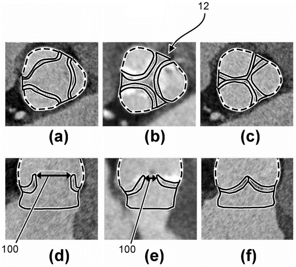 Method and apparatus for simulating blood flow under patient-specific boundary conditions derived from an estimated cardiac ejection output