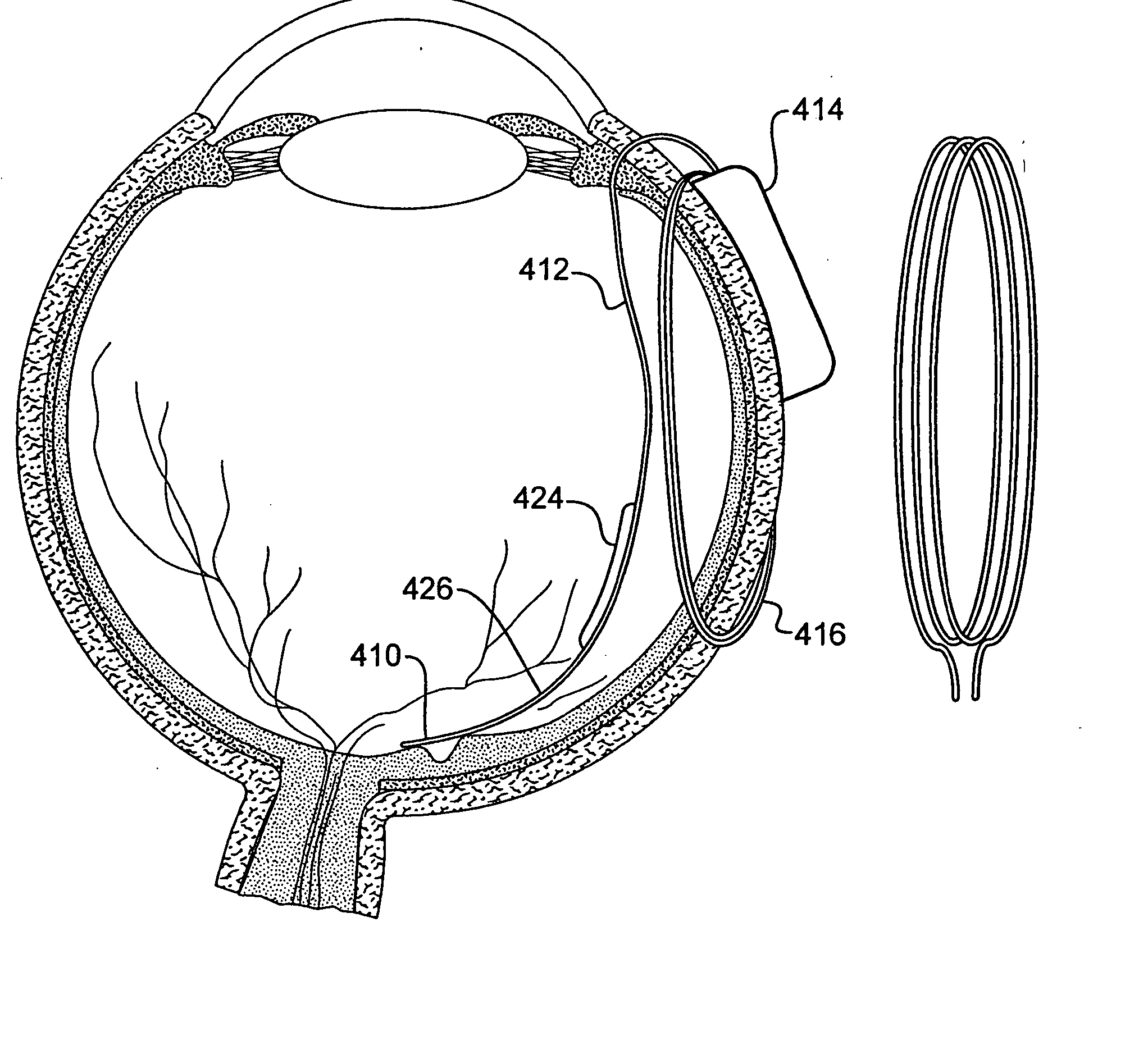 Retinal prosthesis