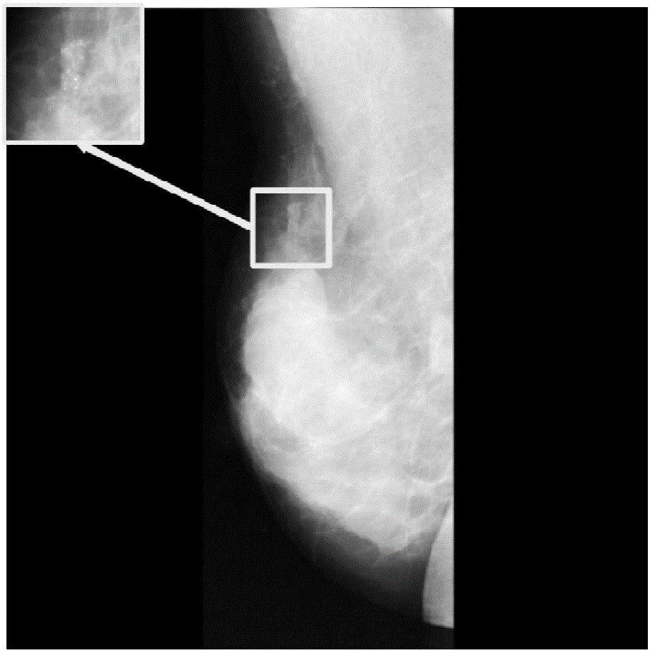 Computer-aided detection method for breast carcinoma calcification point based on local binary pattern and support vector machine