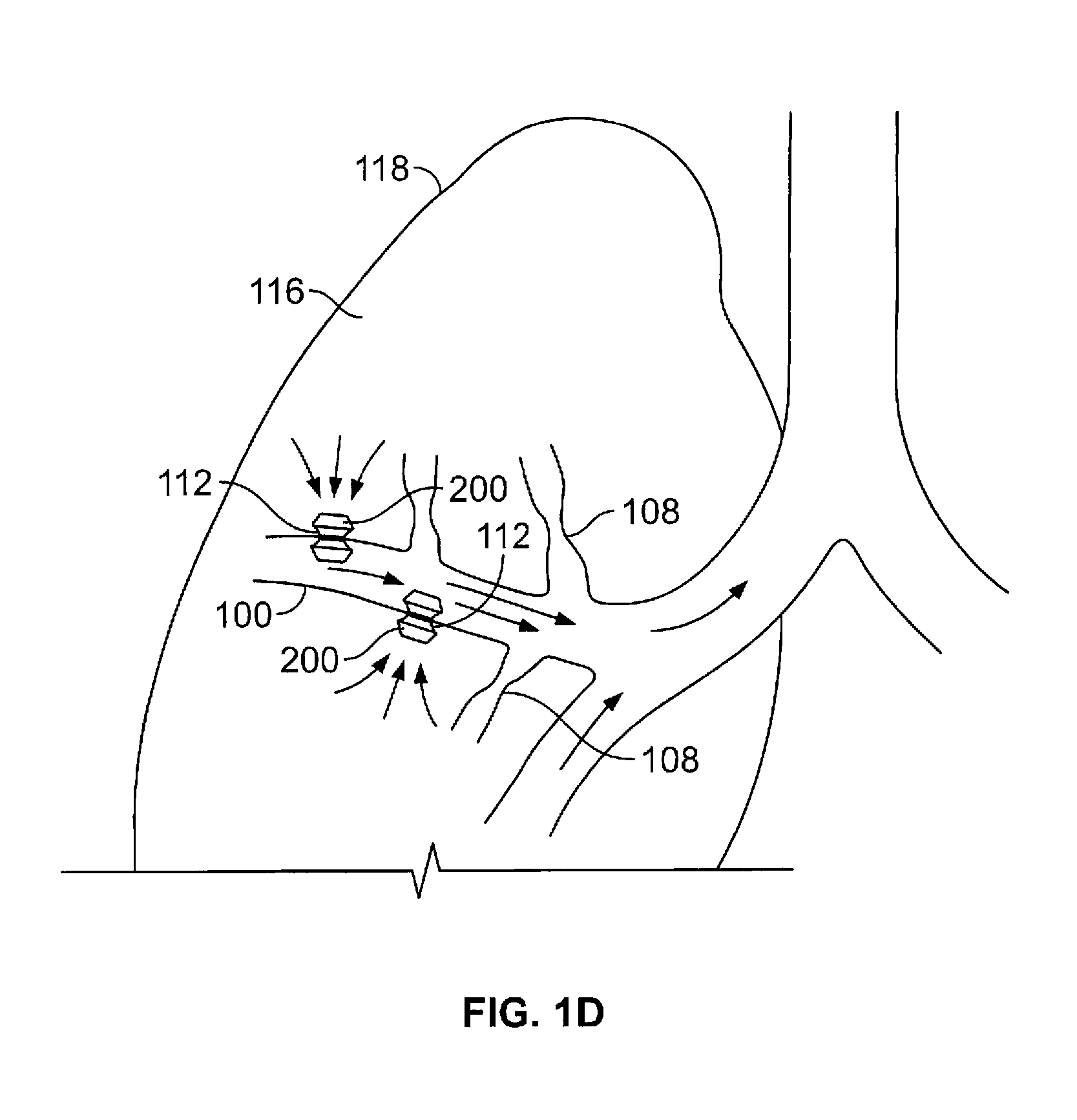 Methods and devices for maintaining patency of surgically created channels in a body organ