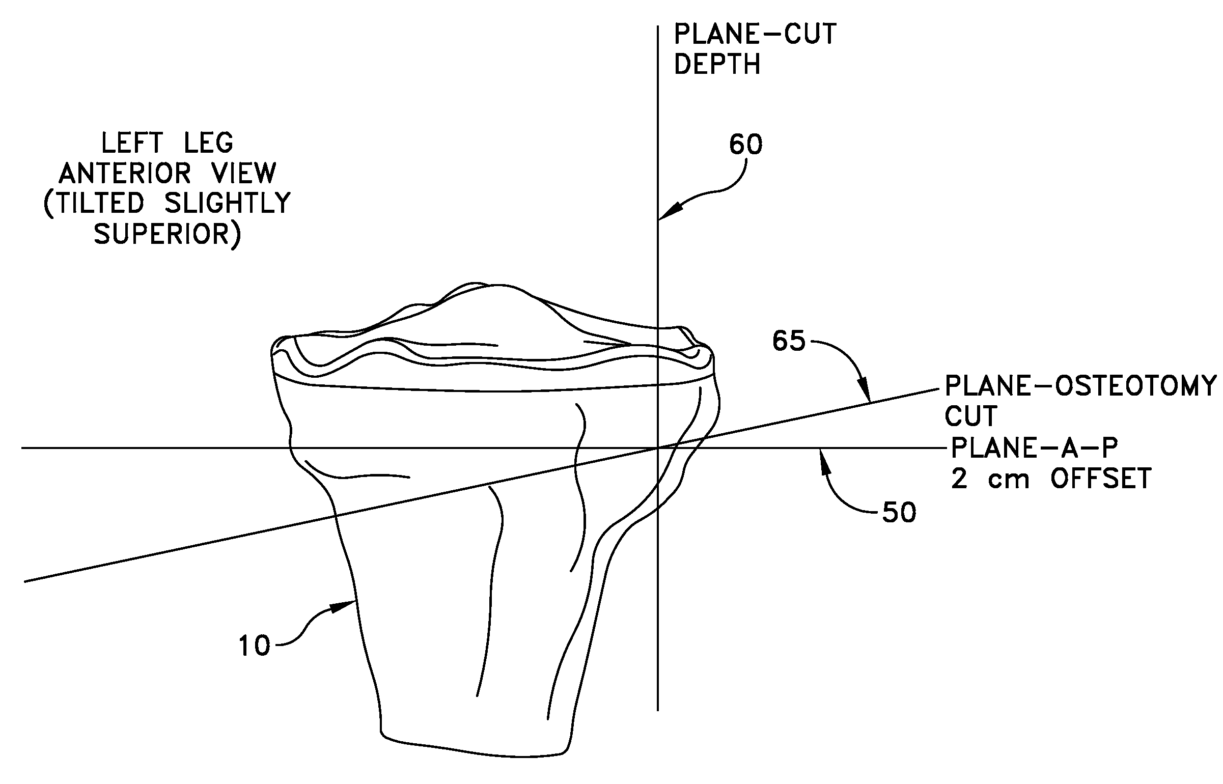 Method and apparatus for performing an open wedge, high tibial osteotomy