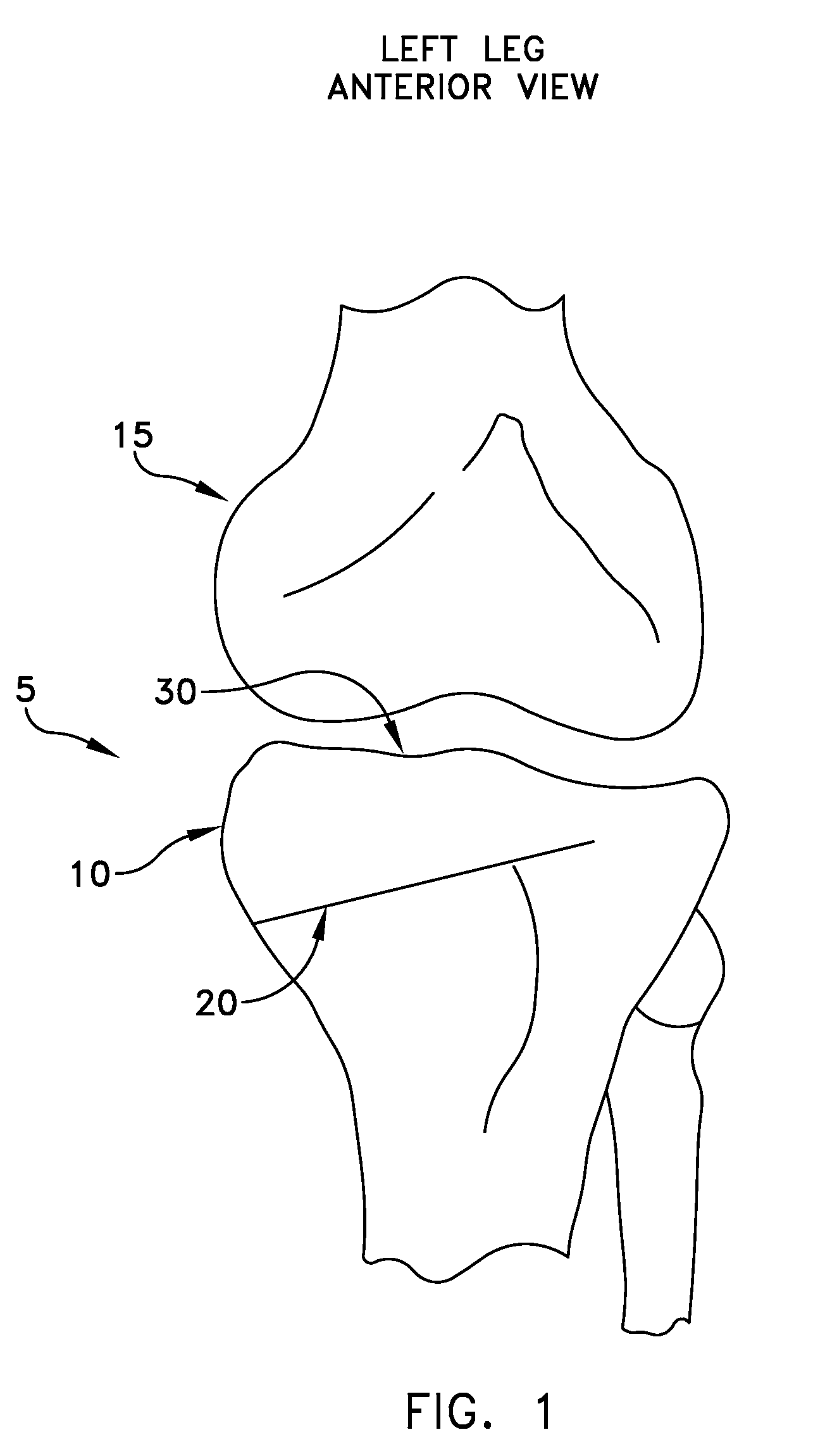 Method and apparatus for performing an open wedge, high tibial osteotomy