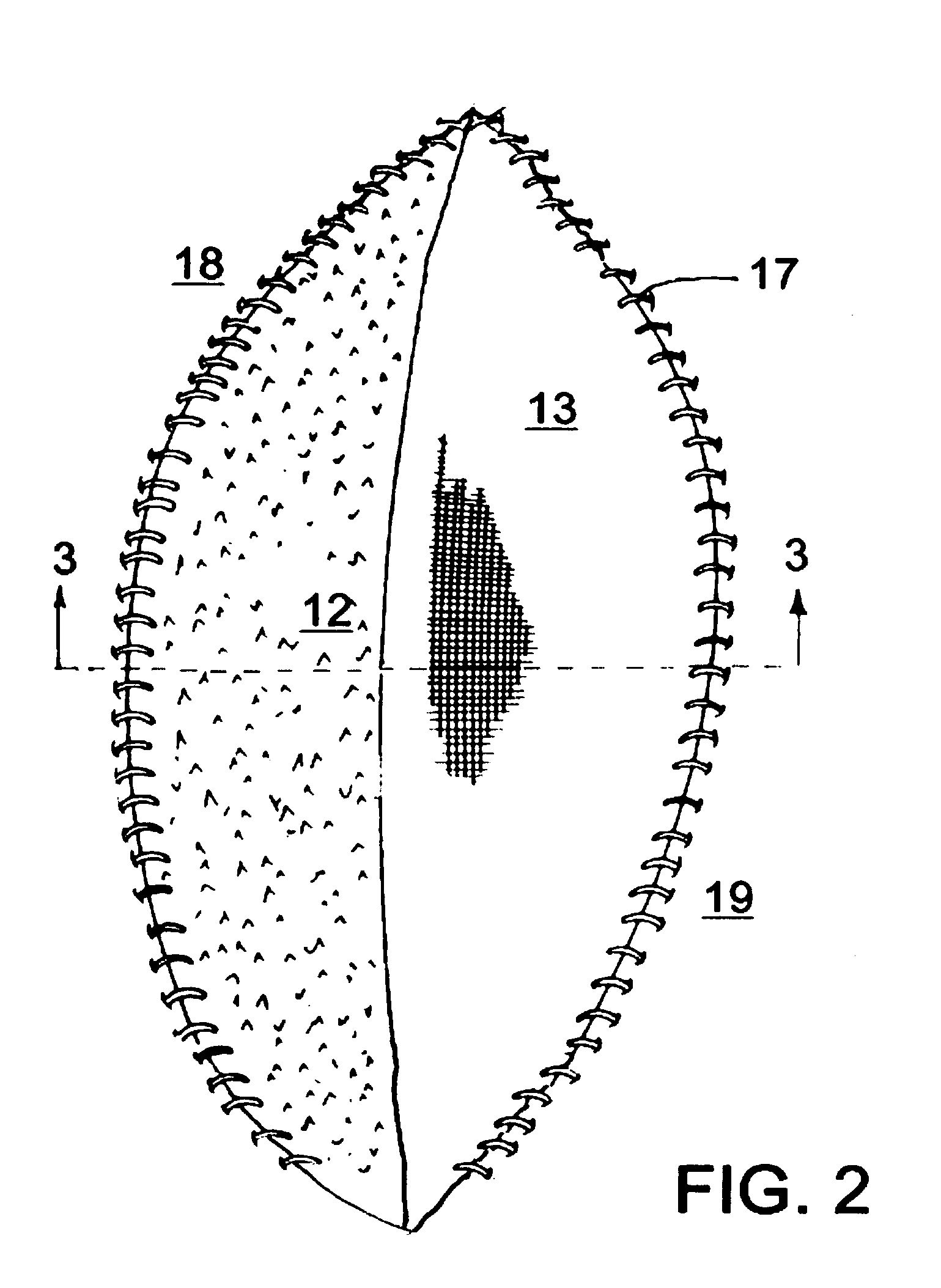 Prosthesis and method for lowering abdominal pressure