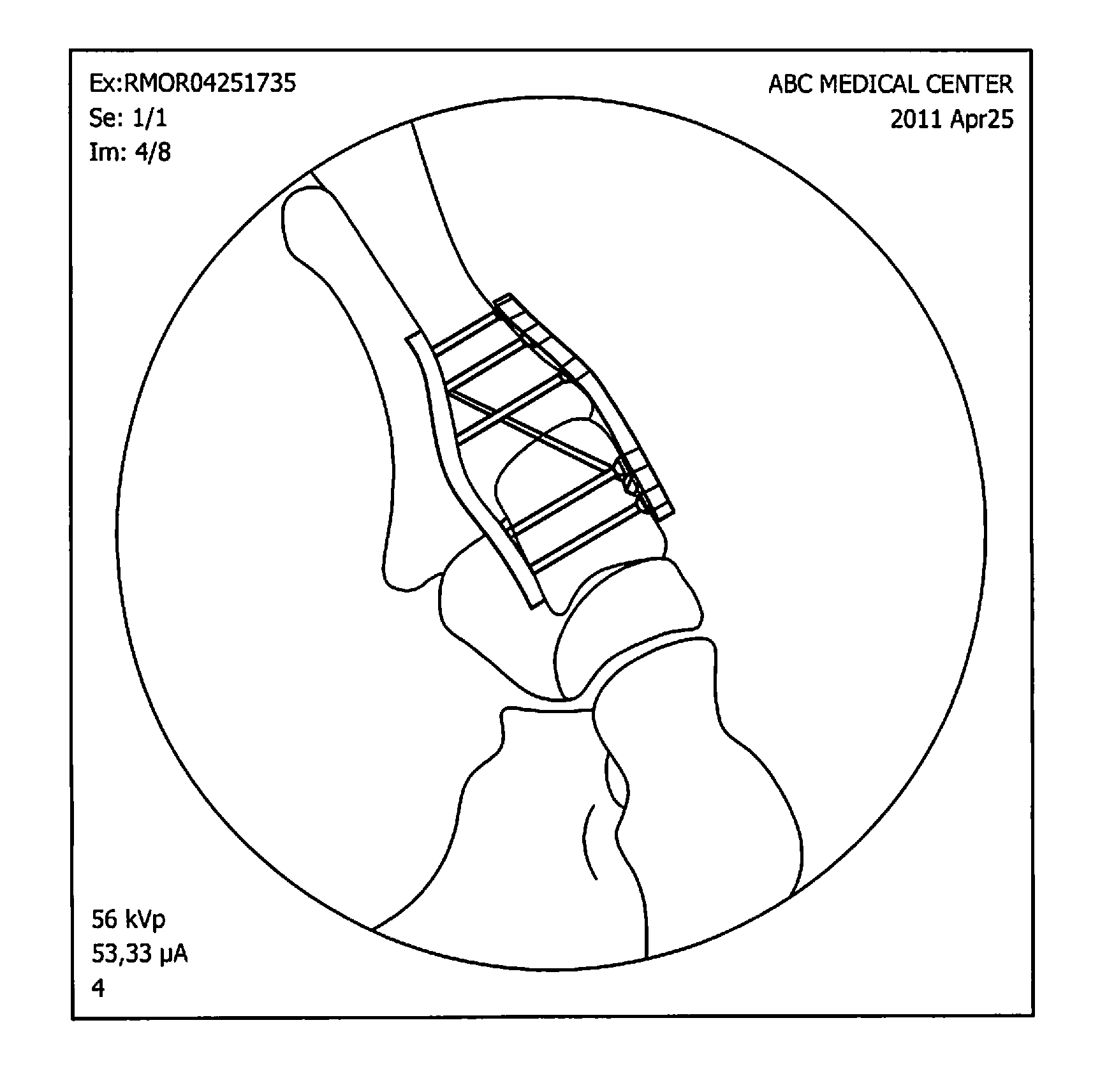 Locking Plate with Screw Fixation from Opposite Cortex