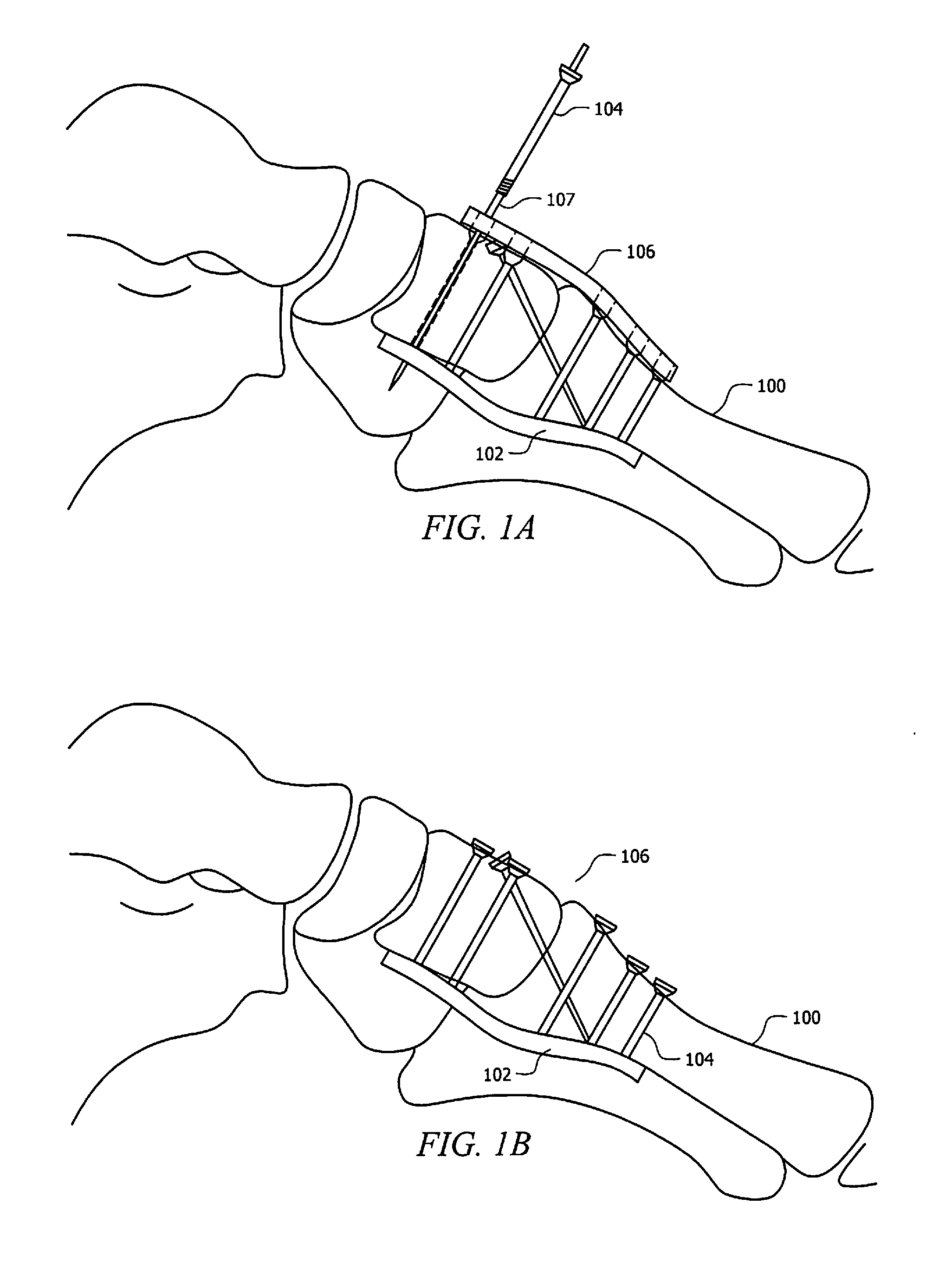 Locking Plate with Screw Fixation from Opposite Cortex