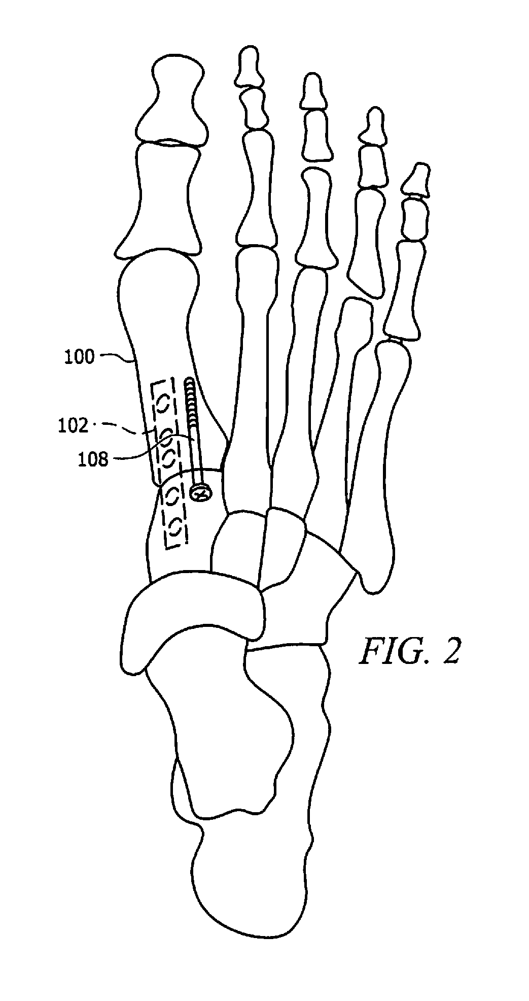 Locking Plate with Screw Fixation from Opposite Cortex