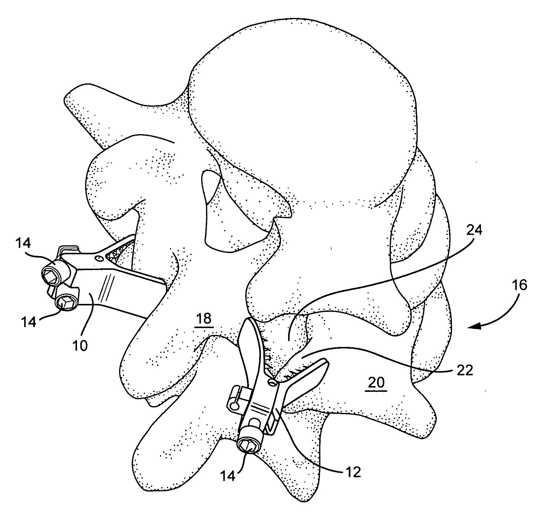 Clamping system and method for fusing vertebral elements in a spine