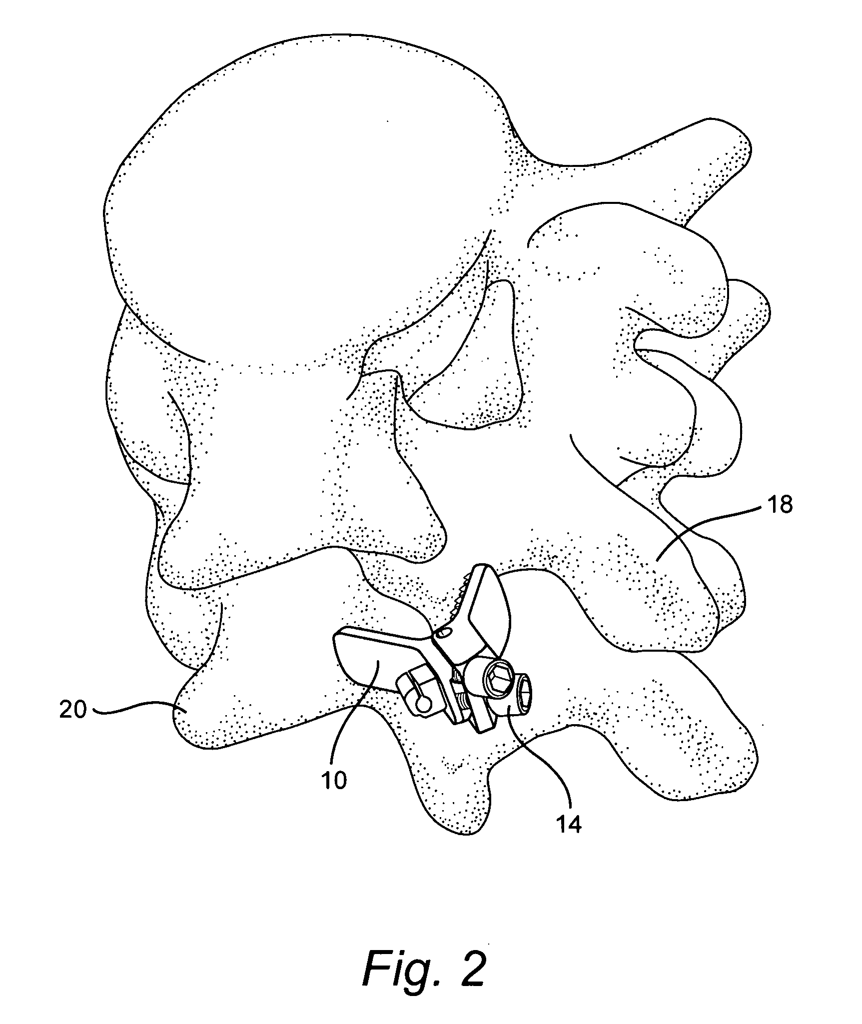 Clamping system and method for fusing vertebral elements in a spine