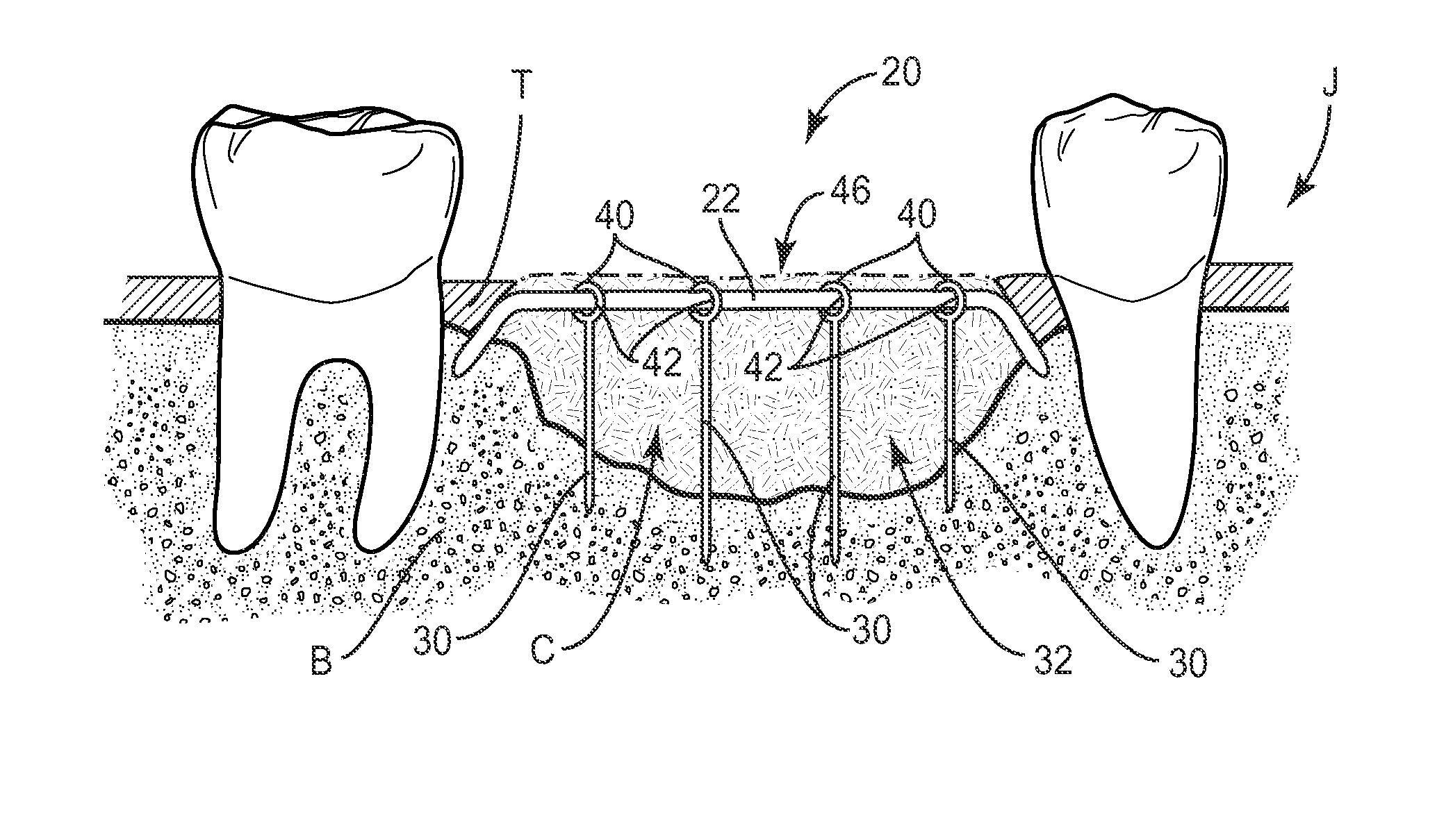 Bone augmentation device