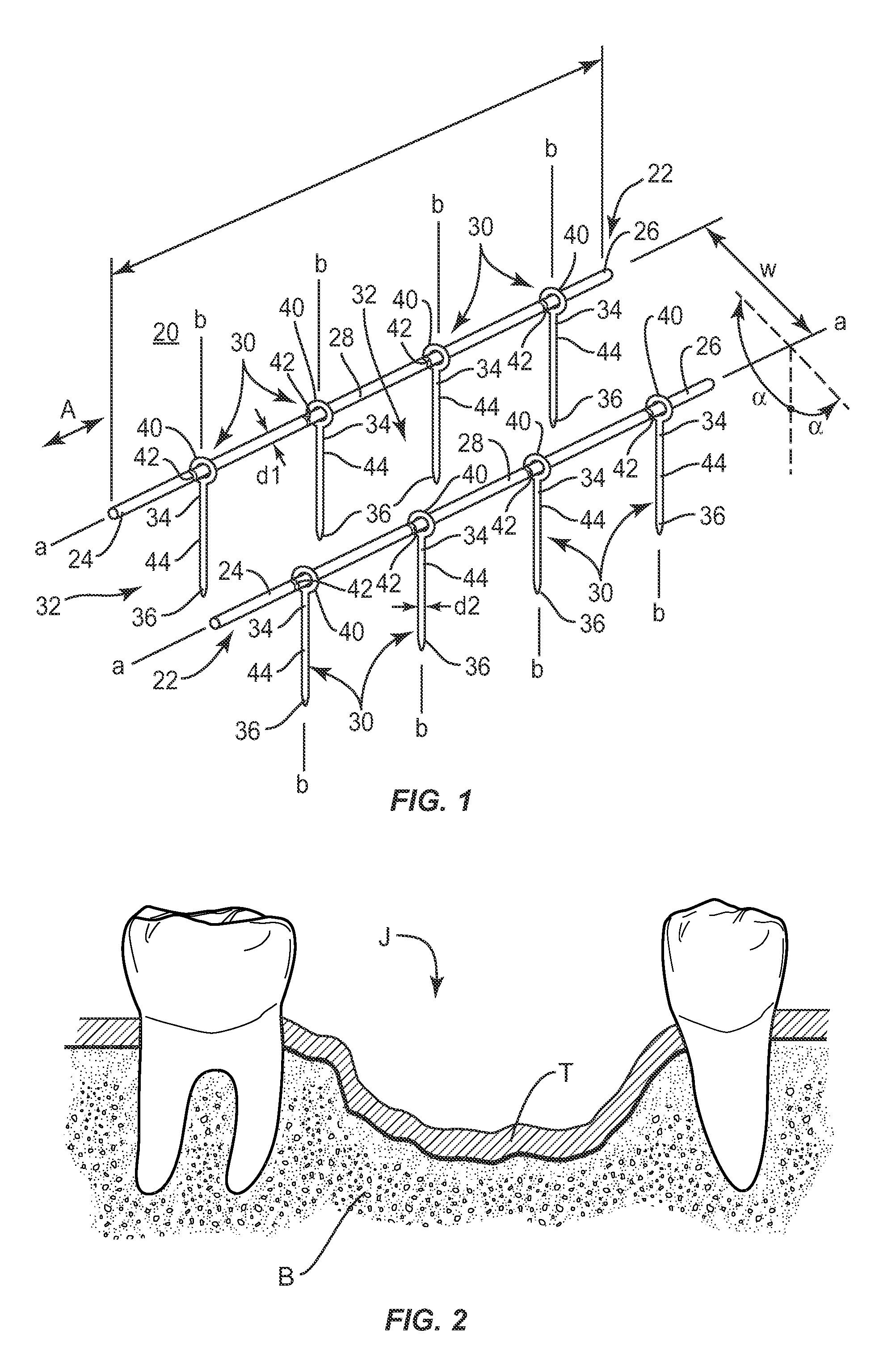 Bone augmentation device