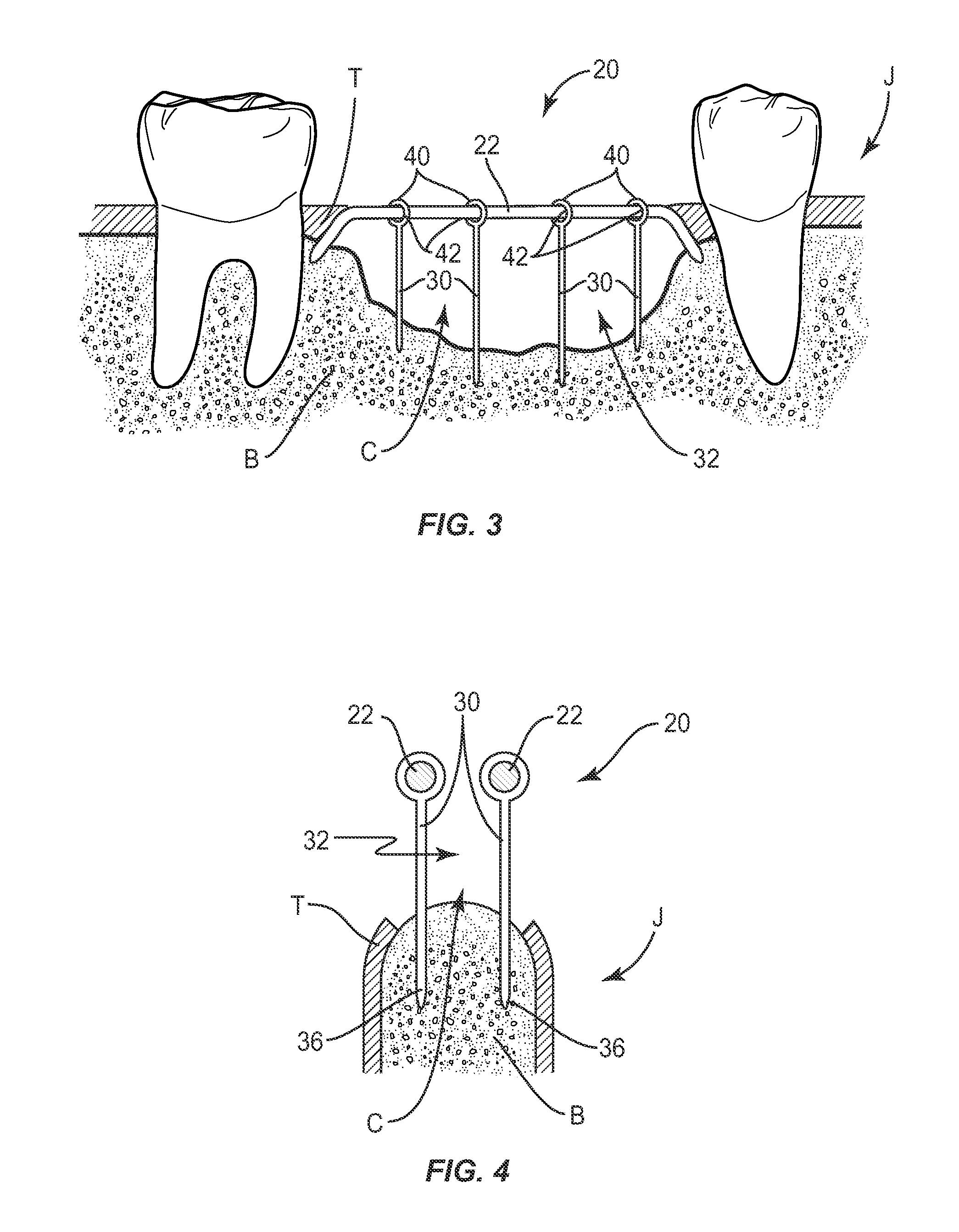 Bone augmentation device