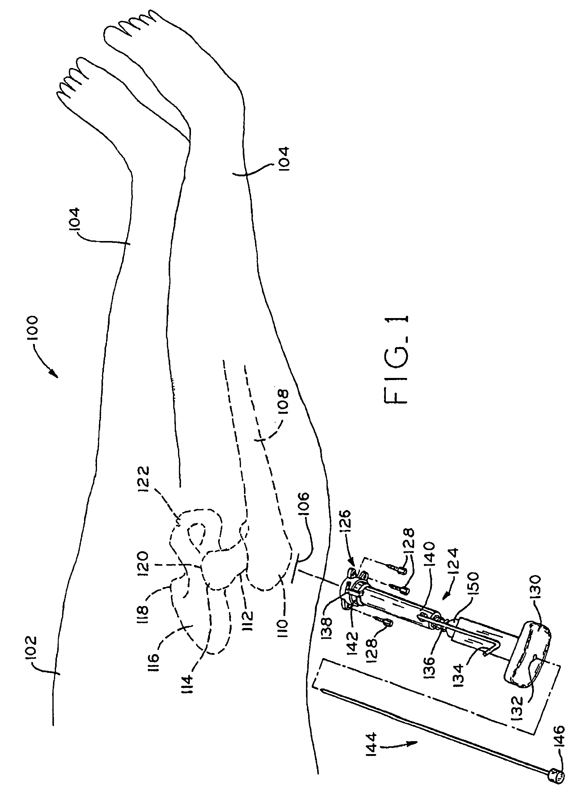 Method and apparatus for reducing femoral fractures