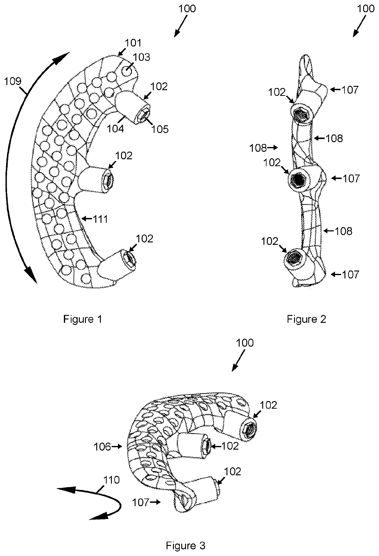 A procedure and orbital implant for orbit anchored bone affixation of an eye prosthesis