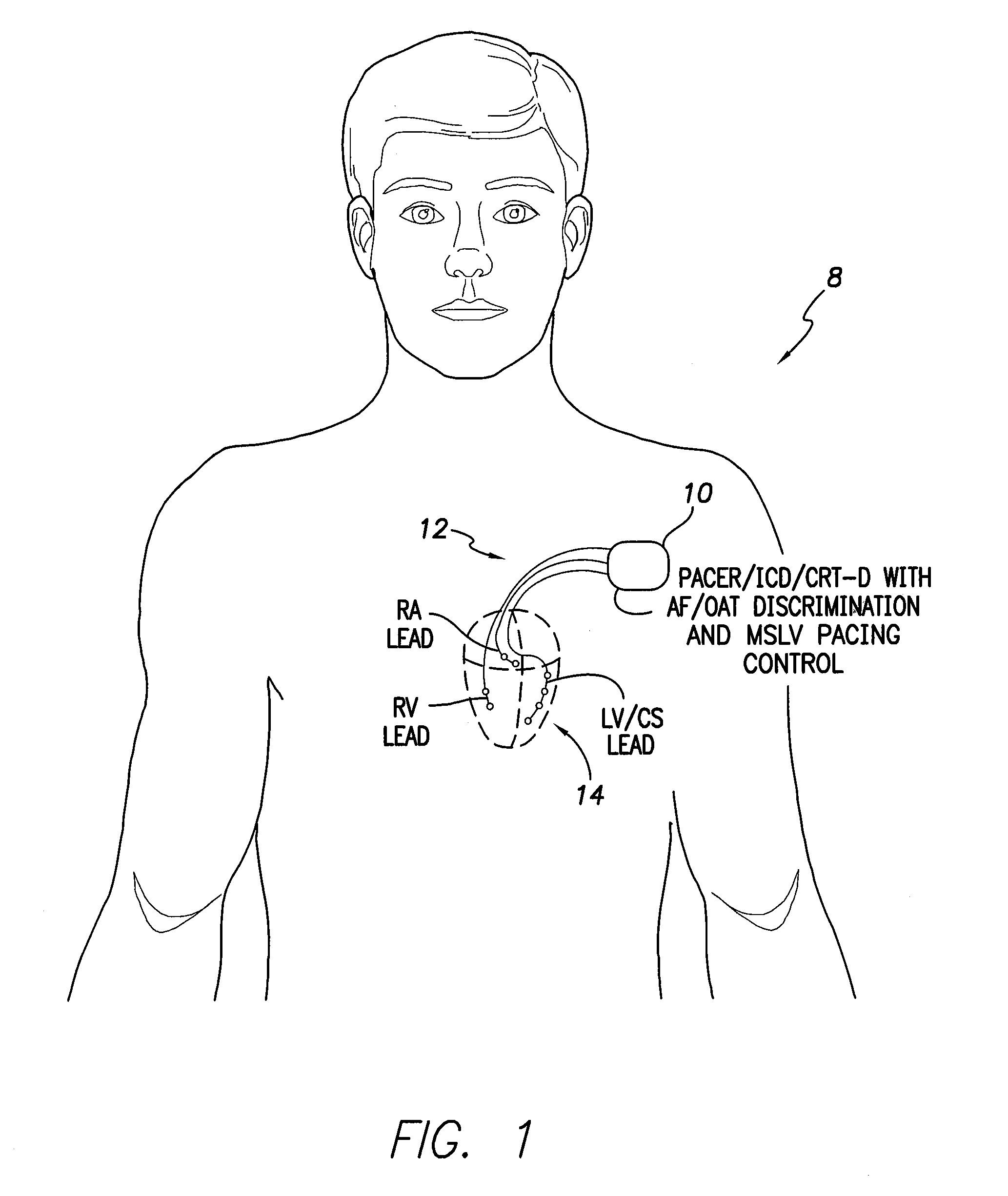 Systems and methods for use by an implantable medical device for controlling multi-site CRT pacing in the presence of atrial tachycardia