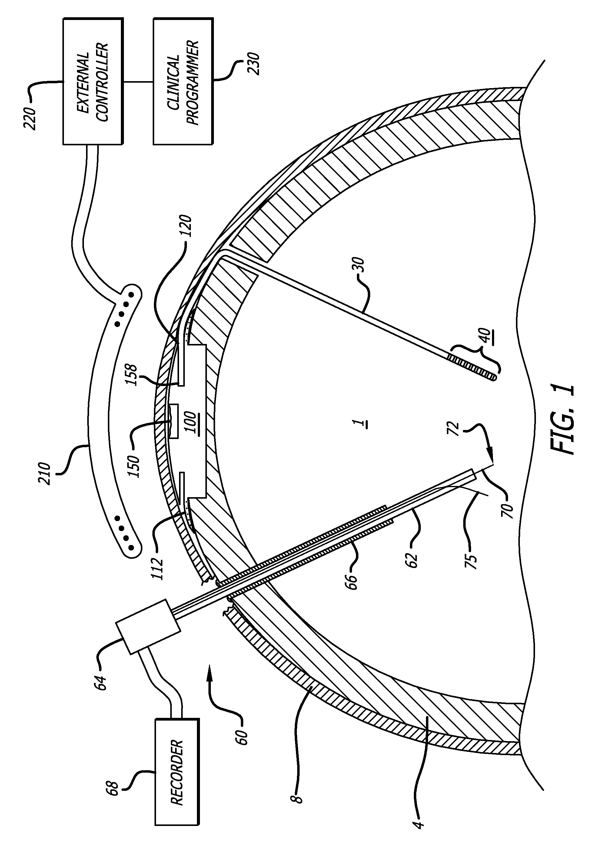 Probe for Identifying Injection Site for Deep Brain Neural Prostheses