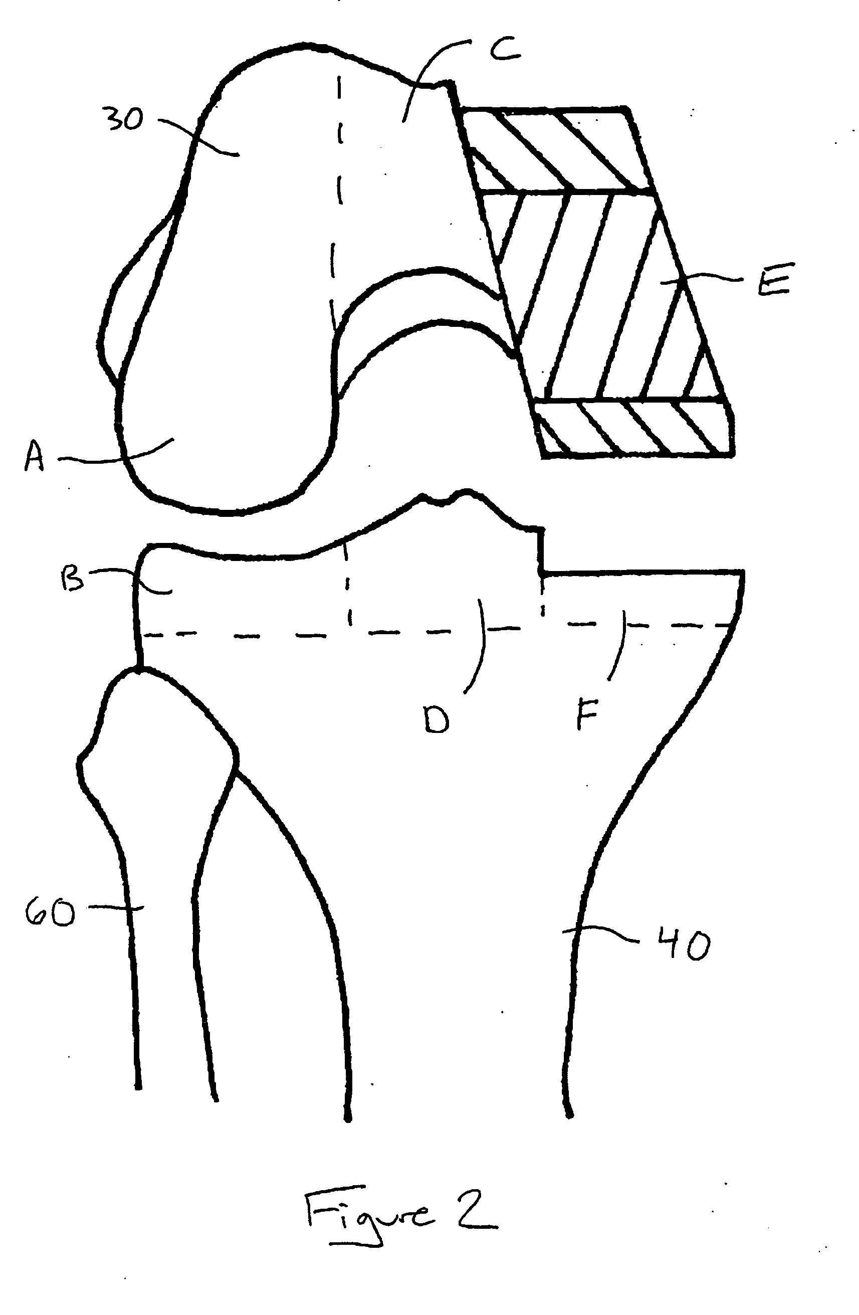 Knee implant