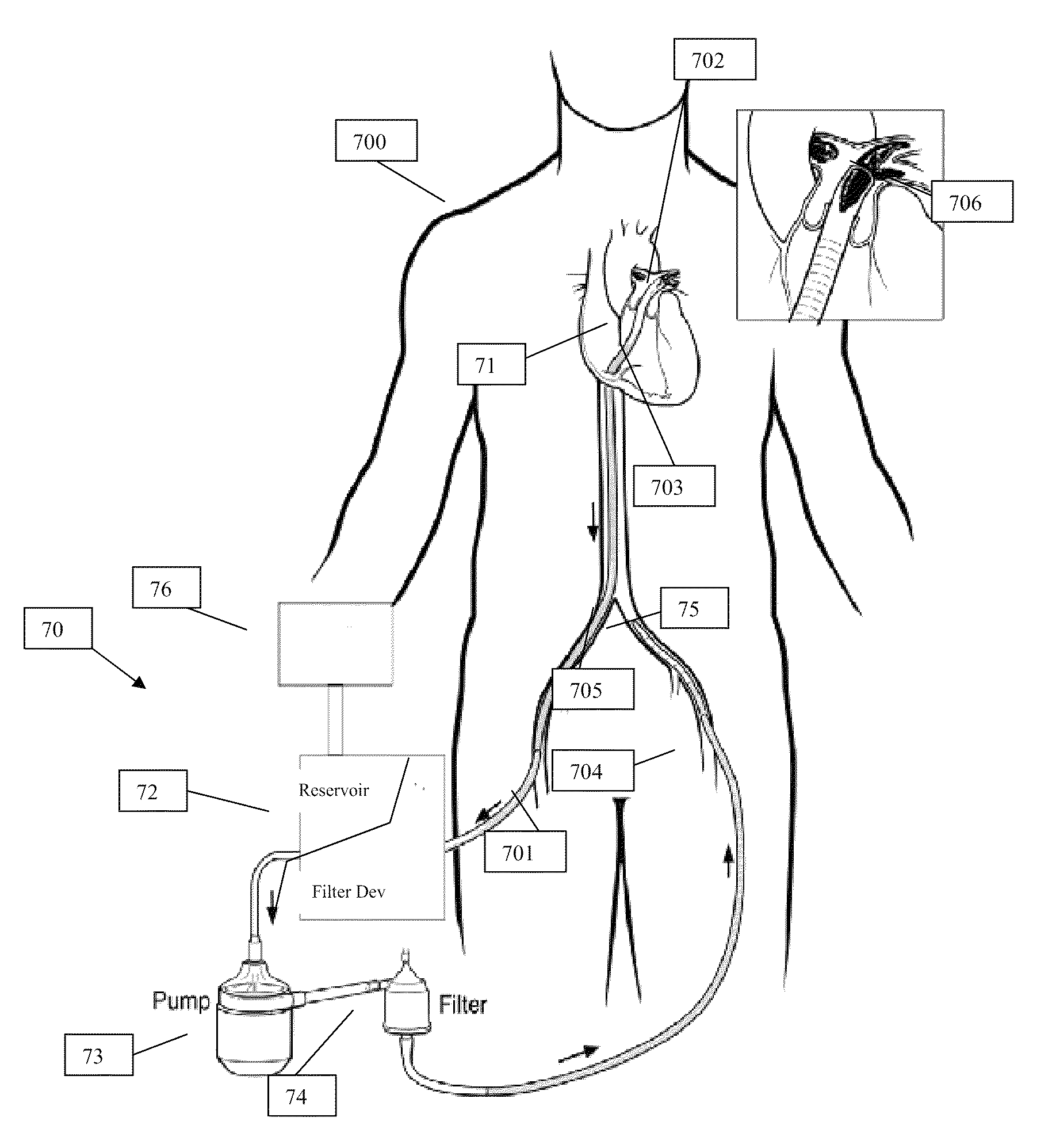 Systems and methods for removing undesirable material within a circulatory system during a surgical procedure