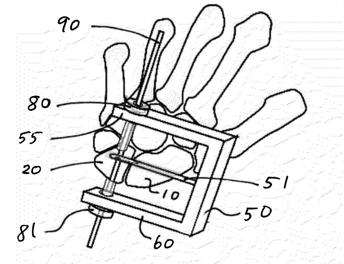 Method and apparatus for articular scapholunate reconstruction