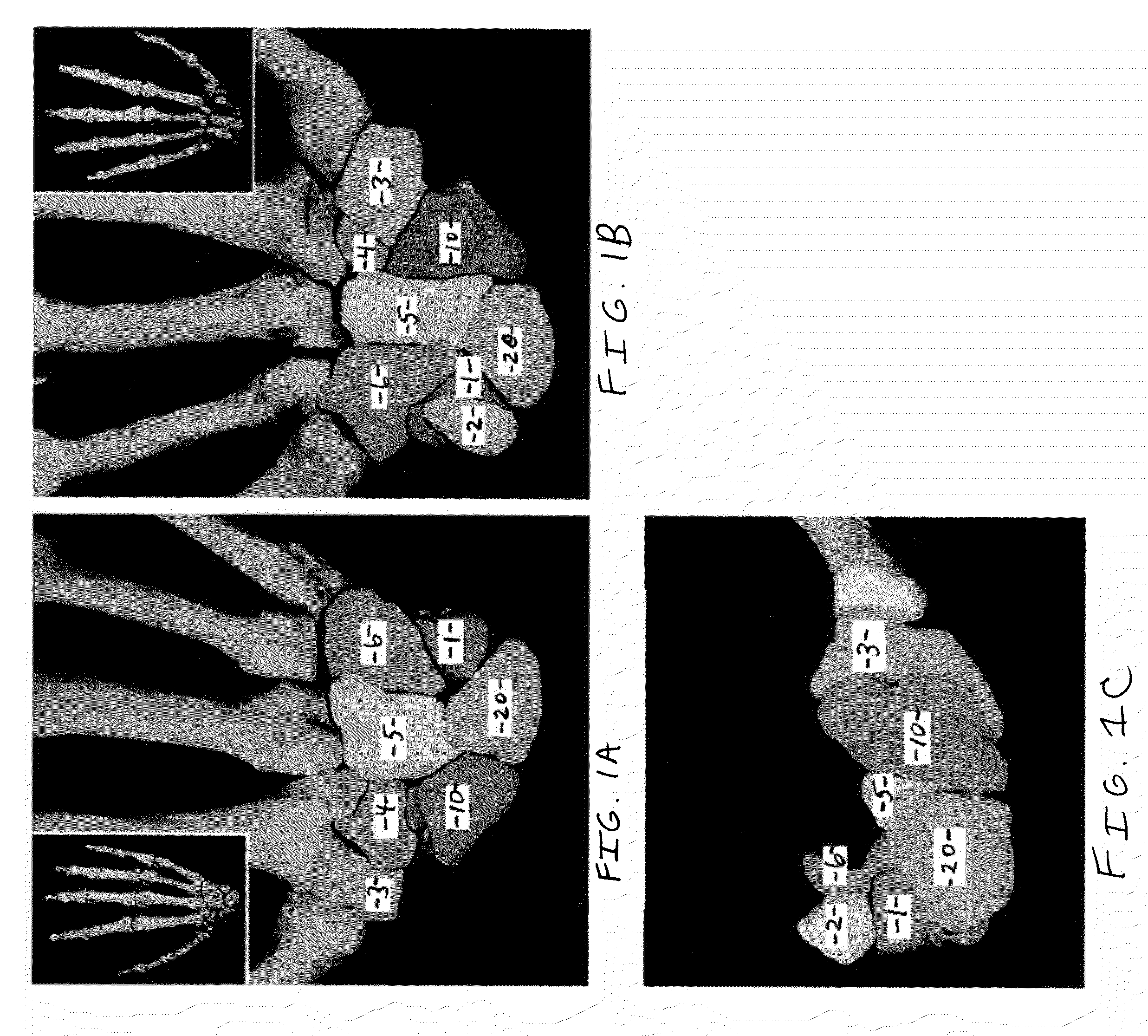 Method and apparatus for articular scapholunate reconstruction