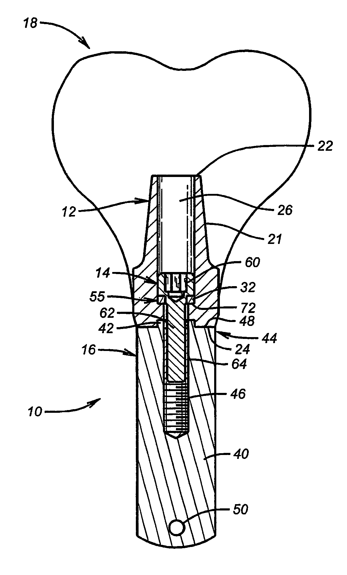 Abutment screw with spring-washer