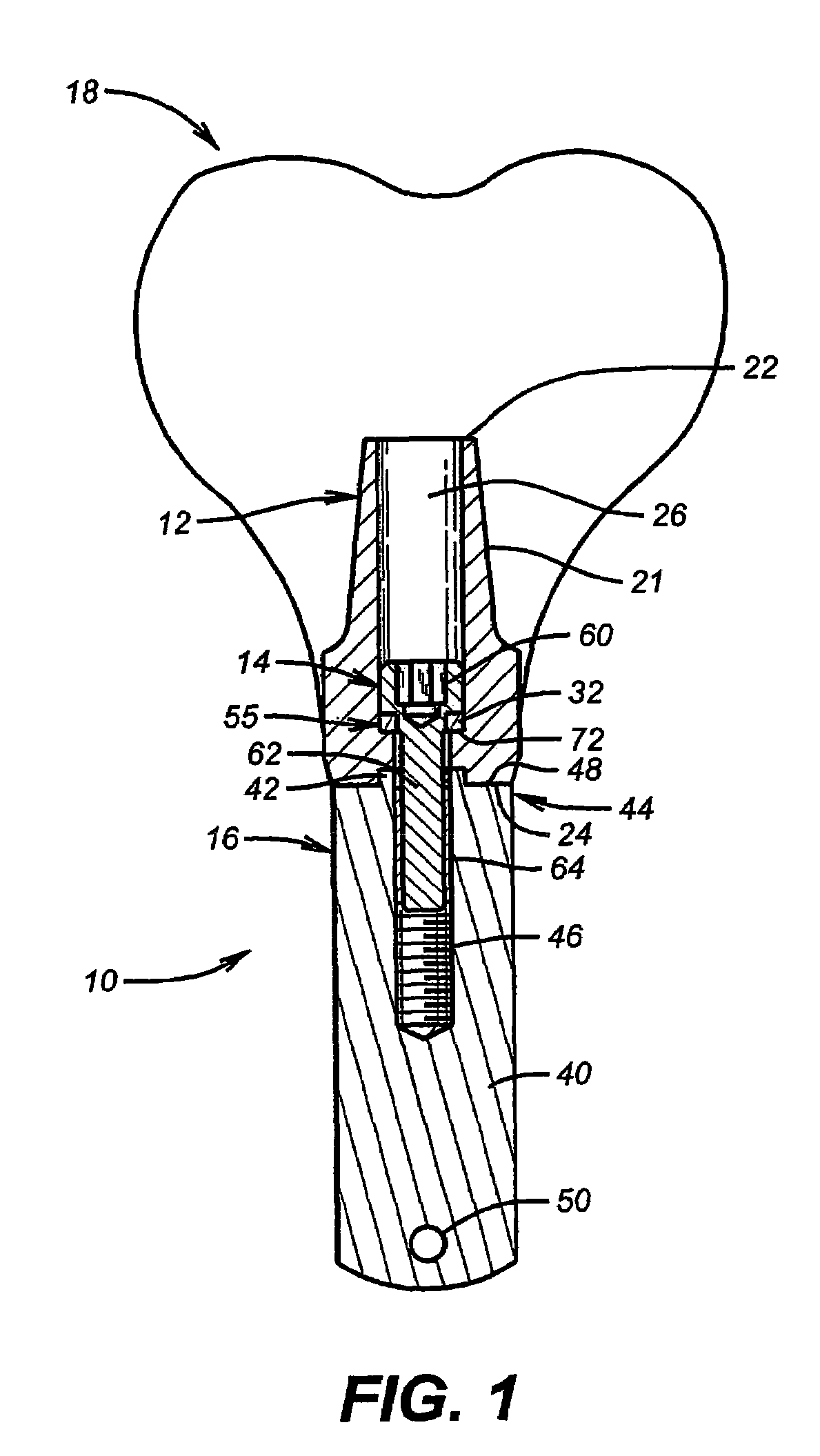 Abutment screw with spring-washer